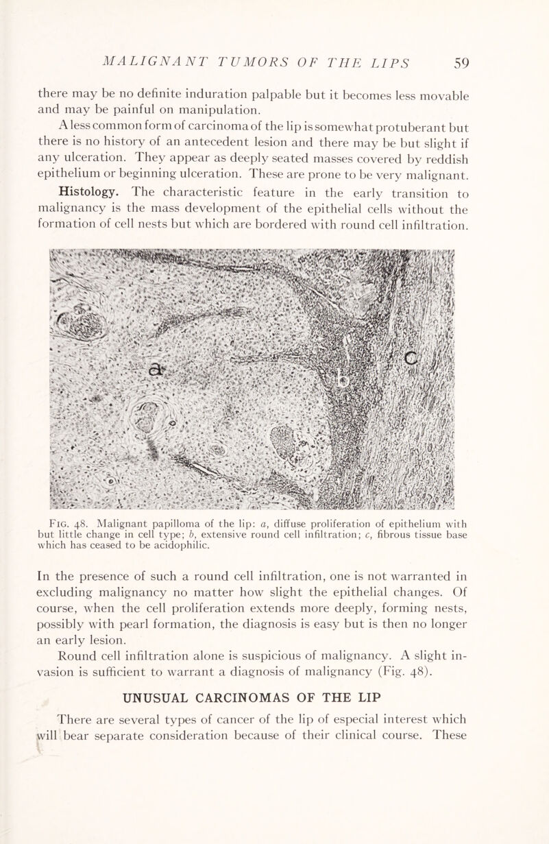 there may be no definite induration palpable but it becomes less movable and may be painful on manipulation. A less common form of carcinoma of the lip is somewhat protuberant but there is no history of an antecedent lesion and there may be but slight if any ulceration. They appear as deeply seated masses covered by reddish epithelium or beginning ulceration. These are prone to be very malignant. Histology. The characteristic feature in the early transition to malignancy is the mass development of the epithelial cells without the formation of cell nests but which are bordered with round cell infiltration. Fig. 48. Malignant papilloma of the lip: a, diffuse proliferation of epithelium with but little change in cell type; b, extensive round cell infiltration; c, fibrous tissue base which has ceased to be acidophilic. In the presence of such a round cell infiltration, one is not warranted in excluding malignancy no matter how slight the epithelial changes. Of course, when the cell proliferation extends more deeply, forming nests, possibly with pearl formation, the diagnosis is easy but is then no longer an early lesion. Round cell infiltration alone is suspicious of malignancy. A slight in¬ vasion is sufficient to warrant a diagnosis of malignancy (Fig. 48). UNUSUAL CARCINOMAS OF THE LIP There are several types of cancer of the lip of especial interest which will bear separate consideration because of their clinical course. These