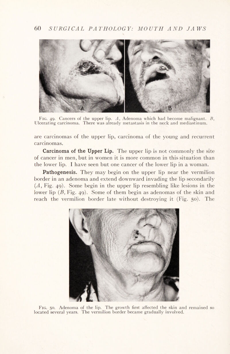 Fig. 49. Cancers of the upper lip. A, Adenoma which had become malignant. B, Ulcerating carcinoma. There was already metastasis in the neck and mediastinum. are carcinomas of the upper lip, carcinoma of the young and recurrent carcinomas. Carcinoma of the Upper Lip. The upper lip is not commonly the site of cancer in men, but in women it is more common in this situation than the lower lip. I have seen but one cancer of the lower lip in a woman. Pathogenesis. They may begin on the upper lip near the vermilion border in an adenoma and extend downward invading the lip secondarily (A, Fig. 49). Some begin in the upper lip resembling like lesions in the lower lip (B, Fig. 49). Some of them begin as adenomas of the skin and reach the vermilion border late without destroying it (Fig. 50). The Fig. 50. Adenoma of the lip. The growth first affected the skin and remained so located several years. The vermilion border became gradually involved.