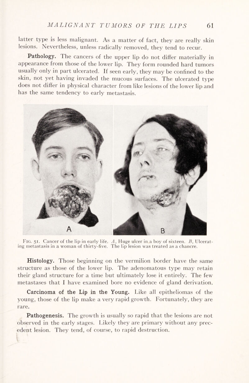 latter type is less malignant. As a matter of fact, they are really skin lesions. Nevertheless, unless radically removed, they tend to recur. Pathology. I he cancers of the upper lip do not differ materially in appearance from those of the lower lip. They form rounded hard tumors usually only in part ulcerated. If seen early, they may be confined to the skin, not yet having invaded the mucous surfaces. The ulcerated type does not differ in physical character from like lesions of the lower lip and has the same tendency to early metastasis. Fig. 51. Cancer of the lip in early life. A, Huge ulcer in a boy of sixteen. B, Ulcerat¬ ing metastasis in a woman of thirty-five. The lip lesion was treated as a chancre. Histology. Those beginning on the vermilion border have the same structure as those of the lower lip. The adenomatous type may retain their gland structure for a time but ultimately lose it entirely. The few metastases that I have examined bore no evidence of gland derivation. Carcinoma of the Lip in the Young. Like all epitheliomas of the young, those of the lip make a very rapid growth. Fortunately, they are rare. Pathogenesis. The growth is usually so rapid that the lesions are not observed in the early stages. Likely they are primary without any prec¬ edent lesion. They tend, of course, to rapid destruction.