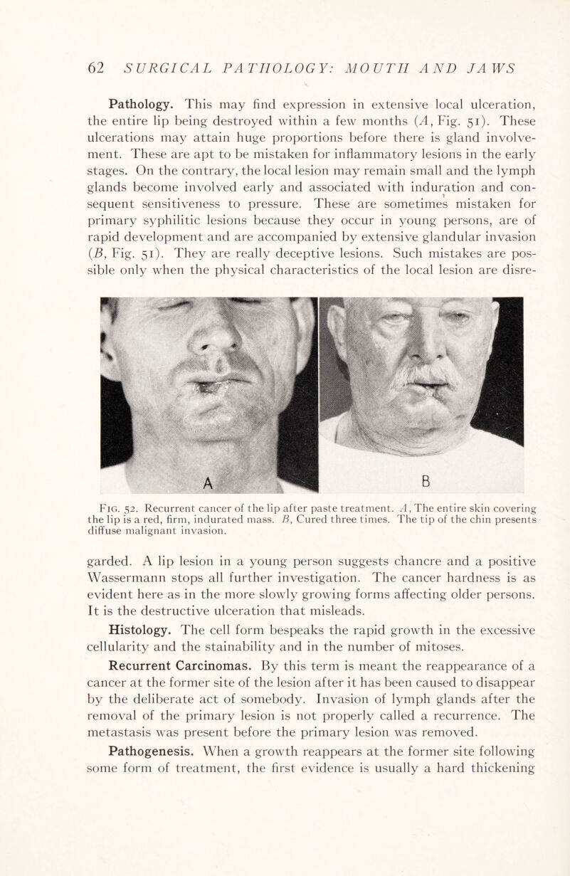 Pathology. This may find expression in extensive local ulceration, the entire lip being destroyed within a few months (A, Fig. 51). These ulcerations may attain huge proportions before there is gland involve¬ ment. These are apt to be mistaken for inflammatory lesions in the early stages. On the contrary, the local lesion may remain small and the lymph glands become involved early and associated with induration and con¬ sequent sensitiveness to pressure. These are sometimes mistaken for primary syphilitic lesions because they occur in young persons, are of rapid development and are accompanied by extensive glandular invasion (B, Fig. 51). They are really deceptive lesions. Such mistakes are pos¬ sible only when the physical characteristics of the local lesion are disre- Fig. 52. Recurrent cancer of the lip after paste treatment. A, The entire skin covering the lip is a red, firm, indurated mass. B, Cured three times. The tip of the chin presents diffuse malignant invasion. garded. A lip lesion in a young person suggests chancre and a positive Wassermann stops all further investigation. The cancer hardness is as evident here as in the more slowly growing forms affecting older persons. It is the destructive ulceration that misleads. Histology. The cell form bespeaks the rapid growth in the excessive cellularity and the stainability and in the number of mitoses. Recurrent Carcinomas. By this term is meant the reappearance of a cancer at the former site of the lesion after it has been caused to disappear by the deliberate act of somebody. Invasion of lymph glands after the removal of the primary lesion is not properly called a recurrence. The metastasis was present before the primary lesion was removed. Pathogenesis. When a growth reappears at the former site following some form of treatment, the first evidence is usually a hard thickening