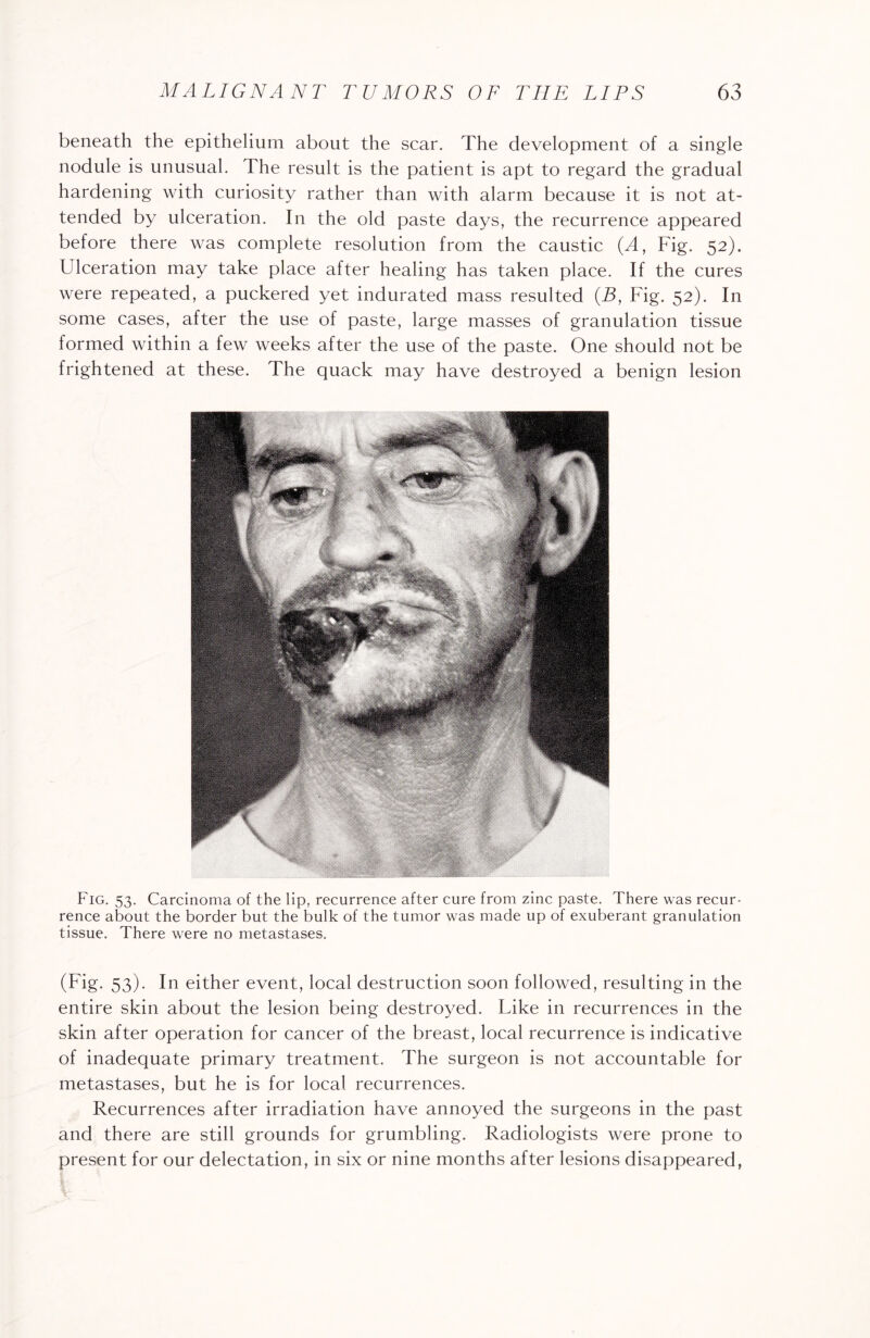beneath the epithelium about the scar. The development of a single nodule is unusual. The result is the patient is apt to regard the gradual hardening with curiosity rather than with alarm because it is not at¬ tended by ulceration. In the old paste days, the recurrence appeared before there was complete resolution from the caustic (A, Fig. 52). Ulceration may take place after healing has taken place. If the cures were repeated, a puckered yet indurated mass resulted (B, Fig. 52). In some cases, after the use of paste, large masses of granulation tissue formed within a few weeks after the use of the paste. One should not be frightened at these. The quack may have destroyed a benign lesion Fig. 53. Carcinoma of the lip, recurrence after cure from zinc paste. There was recur¬ rence about the border but the bulk of the tumor was made up of exuberant granulation tissue. There were no metastases. (Fig- 53)- In either event, local destruction soon followed, resulting in the entire skin about the lesion being destroyed. Like in recurrences in the skin after operation for cancer of the breast, local recurrence is indicative of inadequate primary treatment. The surgeon is not accountable for metastases, but he is for local recurrences. Recurrences after irradiation have annoyed the surgeons in the past and there are still grounds for grumbling. Radiologists were prone to present for our delectation, in six or nine months after lesions disappeared,