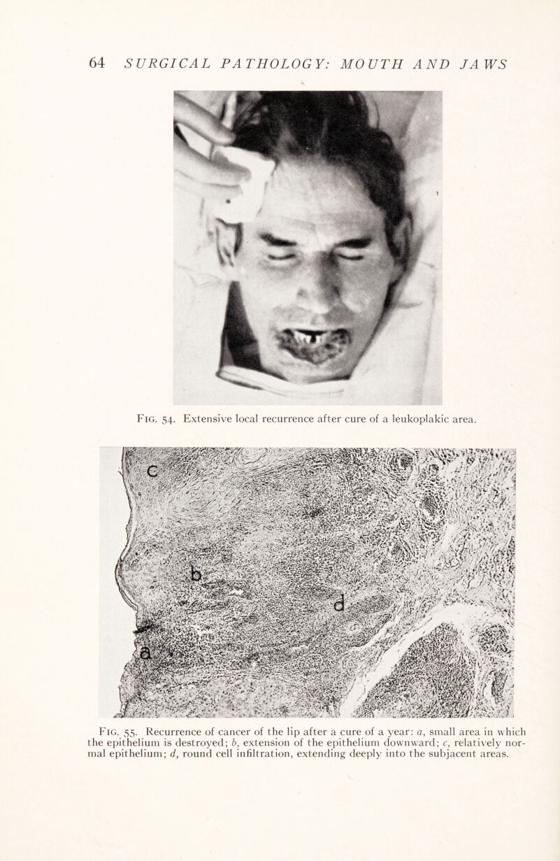 Fig. 54. Extensive local recurrence after cure of a leukoplakic area. swMchmJ', rCf^sF.1 v* *> *»*. * ' Al^Sk., IVp'-v &££ ft {^y*■ * fy 4T**^ Fig. 55. Recurrence of cancer of the lip after a cure of a year: a, small area in which the epithelium is destroyed; b, extension of the epithelium downward; c, relatively nor¬ mal epithelium; d, round cell infiltration, extending deeply into the subjacent areas.