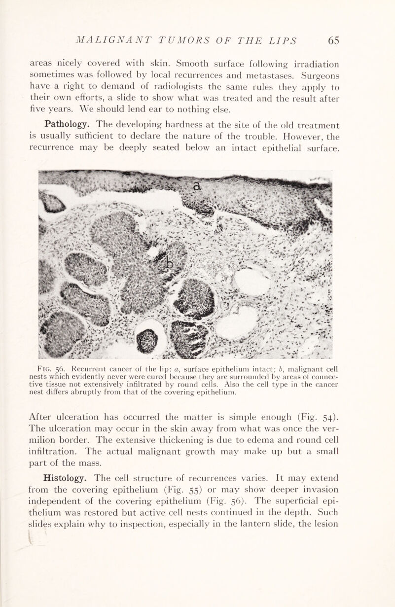 areas nicely covered with skin. Smooth surface following irradiation sometimes was followed by local recurrences and metastases. Surgeons have a right to demand of radiologists the same rules they apply to their own efforts, a slide to show what was treated and the result after five years. We should lend ear to nothing else. Pathology. The developing hardness at the site of the old treatment is usually sufficient to declare the nature of the trouble. However, the recurrence may be deeply seated below an intact epithelial surface. Fig. 56. Recurrent cancer of the lip: a, surface epithelium intact; b, malignant cell nests which evidently never were cured because they are surrounded by areas of connec¬ tive tissue not extensively infiltrated by round cells. Also the cell type in the cancer nest differs abruptly from that of the covering epithelium. After ulceration has occurred the matter is simple enough (Fig. 54). The ulceration may occur in the skin away from what was once the ver¬ milion border. The extensive thickening is due to edema and round cell infiltration. The actual malignant growth may make up but a small part of the mass. Histology. The cell structure of recurrences varies. It may extend from the covering epithelium (Fig. 55) or may show deeper invasion independent of the covering epithelium (Fig. 56). The superficial epi¬ thelium was restored but active cell nests continued in the depth. Such slides explain why to inspection, especially in the lantern slide, the lesion