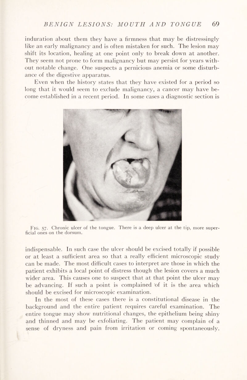 induration about them they have a firmness that may be distressingly like an early malignancy and is often mistaken for such. The lesion may shift its location, healing at one point only to break down at another. They seem not prone to form malignancy but may persist for years with¬ out notable change. One suspects a pernicious anemia or some disturb¬ ance of the digestive apparatus. Even when the history states that they have existed for a period so long that it would seem to exclude malignancy, a cancer may have be¬ come established in a recent period. In some cases a diagnostic section is Fig. 57. Chronic ulcer of the tongue. There is a deep ulcer at the tip, more super¬ ficial ones on the dorsum. indispensable. In such case the ulcer should be excised totally if possible or at least a sufficient area so that a really efficient microscopic study can be made. The most difficult cases to interpret are those in which the patient exhibits a local point of distress though the lesion covers a much wider area. This causes one to suspect that at that point the ulcer may be advancing. If such a point is complained of it is the area which should be excised for microscopic examination. In the most of these cases there is a constitutional disease in the background and the entire patient requires careful examination. The entire tongue may show nutritional changes, the epithelium being shiny and thinned and may be exfoliating. The patient may complain of a sense of dryness and pain from irritation or coming spontaneously.