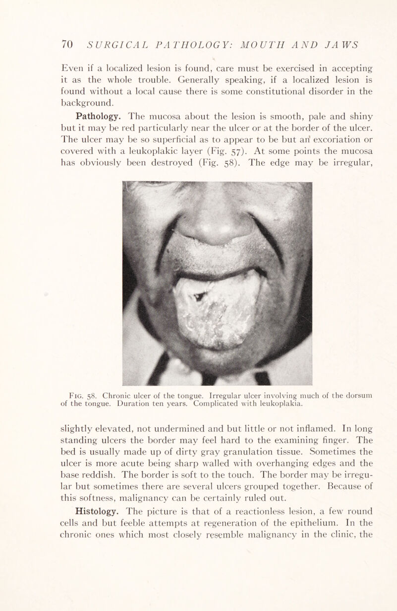 Even if a localized lesion is found, care must be exercised in accepting it as the whole trouble. Generally speaking, if a localized lesion is found without a local cause there is some constitutional disorder in the background. Pathology. The mucosa about the lesion is smooth, pale and shiny but it may be red particularly near the ulcer or at the border of the ulcer. The ulcer may be so superficial as to appear to be but an excoriation or covered with a leukoplakic layer (Fig. 57). At some points the mucosa has obviously been destroyed (Fig. 58). The edge may be irregular, Fig. 58. Chronic ulcer of the tongue. Irregular ulcer involving much of the dorsum of the tongue. Duration ten years. Complicated with leukoplakia. slightly elevated, not undermined and but little or not inflamed. In long standing ulcers the border may feel hard to the examining finger. The bed is usually made up of dirty gray granulation tissue. Sometimes the ulcer is more acute being sharp walled with overhanging edges and the base reddish. The border is soft to the touch. The border may be irregu¬ lar but sometimes there are several ulcers grouped together. Because of this softness, malignancy can be certainly ruled out. Histology. The picture is that of a reactionless lesion, a few round cells and but feeble attempts at regeneration of the epithelium. In the chronic ones which most closely resemble malignancy in the clinic, the