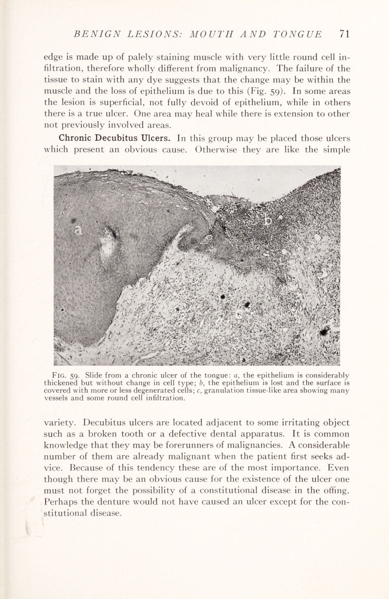 edge is made up of palely staining muscle with very little round cell in¬ filtration, therefore wholly different from malignancy. The failure of the tissue to stain with any dye suggests that the change may be within the muscle and the loss of epithelium is due to this (Fig. 59). In some areas the lesion is superficial, not fully devoid of epithelium, while in others there is a true ulcer. One area may heal while there is extension to other not previously involved areas. Chronic Decubitus Ulcers. In this group may be placed those ulcers which present an obvious cause. Otherwise they are like the simple Fig. 59. Slide from a chronic ulcer of the tongue: a, the epithelium is considerably thickened but without change in cell type; b, the epithelium is lost and the surface is covered with more or less degenerated cells; c, granulation tissuedike area showing many vessels and some round cell infiltration. variety. Decubitus ulcers are located adjacent to some irritating object such as a broken tooth or a defective dental apparatus. It is common knowledge that they may be forerunners of malignancies. A considerable number of them are already malignant when the patient first seeks ad¬ vice. Because of this tendency these are of the most importance. Even though there may be an obvious cause for the existence of the ulcer one must not forget the possibility of a constitutional disease in the offing. Perhaps the denture would not have caused an ulcer except for the con¬ stitutional disease.