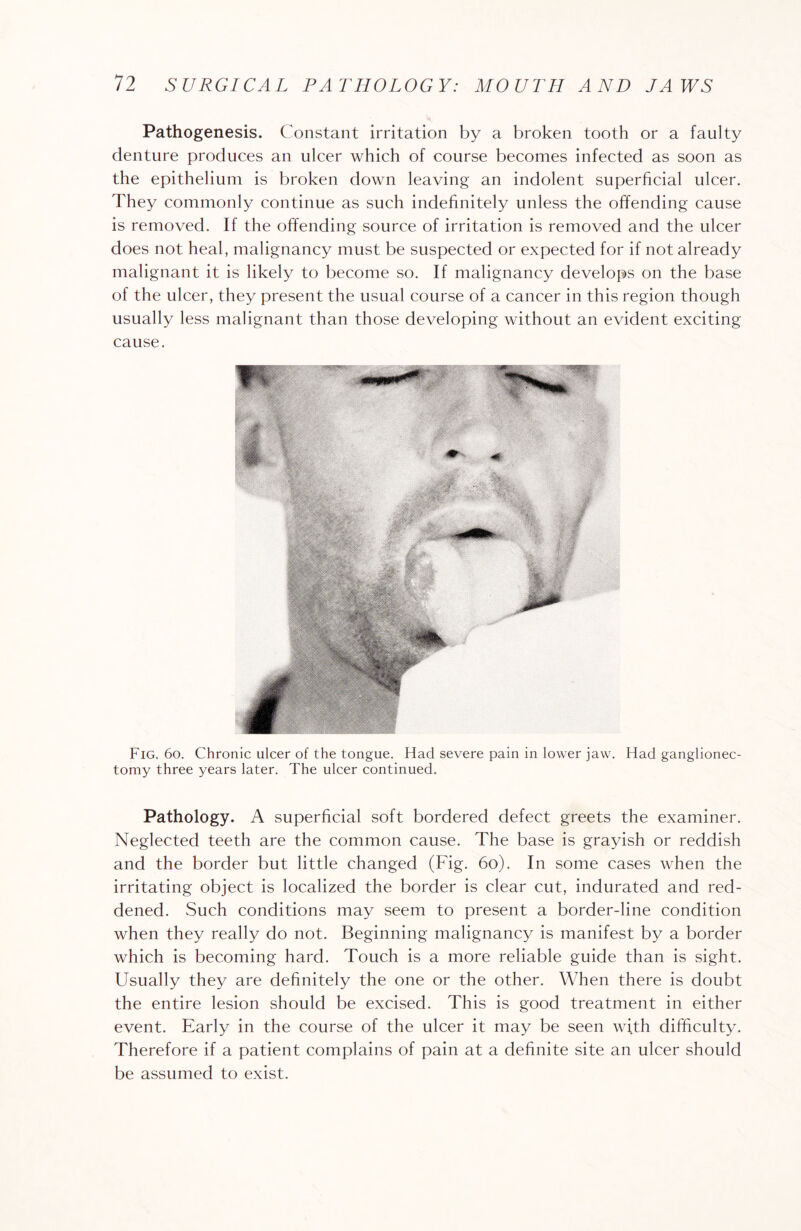 Pathogenesis. Constant irritation by a broken tooth or a faulty denture produces an ulcer which of course becomes infected as soon as the epithelium is broken down leaving an indolent superficial ulcer. They commonly continue as such indefinitely unless the offending cause is removed. If the offending source of irritation is removed and the ulcer does not heal, malignancy must be suspected or expected for if not already malignant it is likely to become so. If malignancy develops on the base of the ulcer, they present the usual course of a cancer in this region though usually less malignant than those developing without an evident exciting cause. Fig. 6o. Chronic ulcer of the tongue. Had severe pain in lower jaw. Had ganglionec- tomy three years later. The ulcer continued. Pathology. A superficial soft bordered defect greets the examiner. Neglected teeth are the common cause. The base is grayish or reddish and the border but little changed (Fig. 60). In some cases when the irritating object is localized the border is clear cut, indurated and red¬ dened. Such conditions may seem to present a border-line condition when they really do not. Beginning malignancy is manifest by a border which is becoming hard. Touch is a more reliable guide than is sight. Usually they are definitely the one or the other. When there is doubt the entire lesion should be excised. This is good treatment in either event. Early in the course of the ulcer it may be seen with difficulty. Therefore if a patient complains of pain at a definite site an ulcer should be assumed to exist.