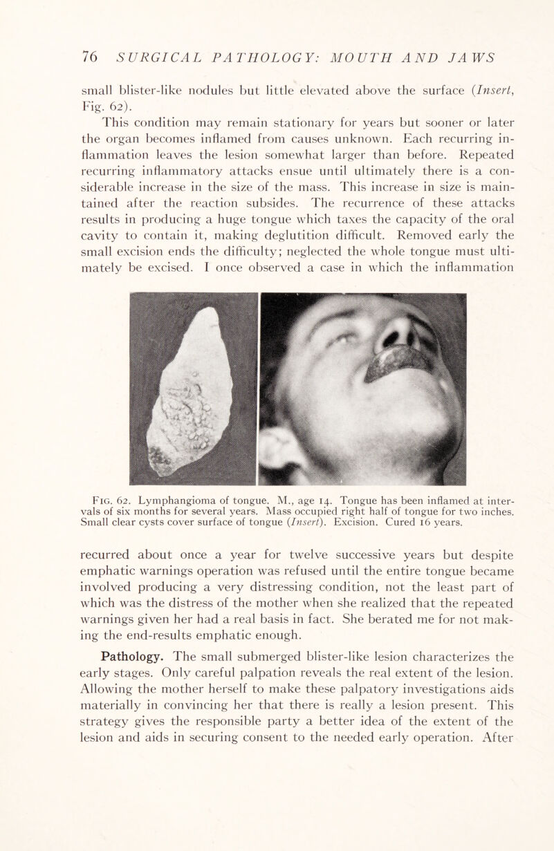 small blister-like nodules but little elevated above the surface (Insert, Fig. 62). This condition may remain stationary for years but sooner or later the organ becomes inflamed from causes unknown. Each recurring in¬ flammation leaves the lesion somewhat larger than before. Repeated recurring inflammatory attacks ensue until ultimately there is a con¬ siderable increase in the size of the mass. This increase in size is main¬ tained after the reaction subsides. The recurrence of these attacks results in producing a huge tongue which taxes the capacity of the oral cavity to contain it, making deglutition difficult. Removed early the small excision ends the difficulty; neglected the whole tongue must ulti¬ mately be excised. I once observed a case in which the inflammation Fig. 62. Lymphangioma of tongue. M., age 14. Tongue has been inflamed at inter¬ vals of six months for several years. Mass occupied right half of tongue for two inches. Small clear cysts cover surface of tongue {Insert). Excision. Cured 16 years. recurred about once a year for twelve successive years but despite emphatic warnings operation was refused until the entire tongue became involved producing a very distressing condition, not the least part of which was the distress of the mother when she realized that the repeated warnings given her had a real basis in fact. She berated me for not mak¬ ing the end-results emphatic enough. Pathology. The small submerged blister-like lesion characterizes the early stages. Only careful palpation reveals the real extent of the lesion. Allowing the mother herself to make these palpatory investigations aids materially in convincing her that there is really a lesion present. This strategy gives the responsible party a better idea of the extent of the lesion and aids in securing consent to the needed early operation. After