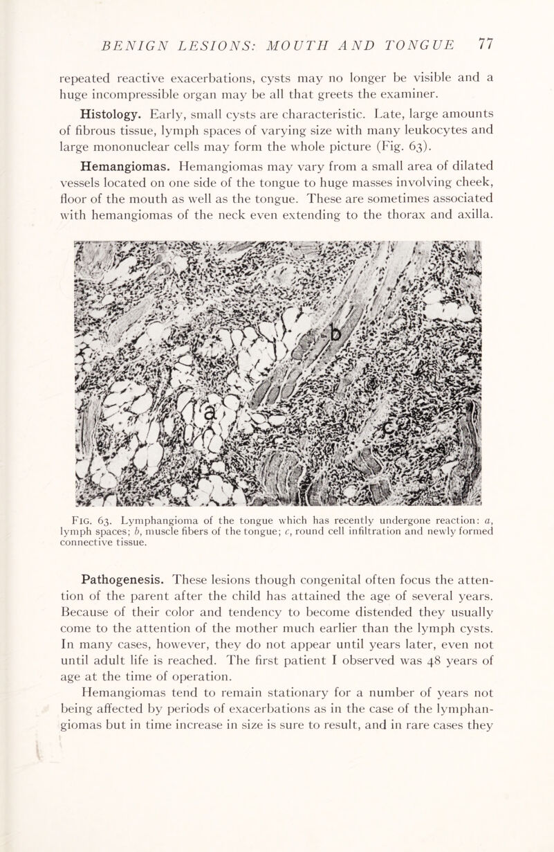 repeated reactive exacerbations, cysts may no longer be visible and a huge incompressible organ may be all that greets the examiner. Histology. Early, small cysts are characteristic. Late, large amounts of fibrous tissue, lymph spaces of varying size with many leukocytes and large mononuclear cells may form the whole picture (Fig. 63). Hemangiomas. Hemangiomas may vary from a small area of dilated vessels located on one side of the tongue to huge masses involving cheek, floor of the mouth as well as the tongue. These are sometimes associated with hemangiomas of the neck even extending to the thorax and axilla. Fig. 63. Lymphangioma of the tongue which has recently undergone reaction: a, lymph spaces; b, muscle fibers of the tongue; c, round cell infiltration and newly formed connective tissue. Pathogenesis. These lesions though congenital often focus the atten¬ tion of the parent after the child has attained the age of several years. Because of their color and tendency to become distended they usually come to the attention of the mother much earlier than the lymph cysts. In many cases, however, they do not appear until years later, even not until adult life is reached. The first patient I observed was 48 years of age at the time of operation. Hemangiomas tend to remain stationary for a number of years not being affected by periods of exacerbations as in the ca.se of the lymphan¬ giomas but in time increase in size is sure to result, and in rare cases they