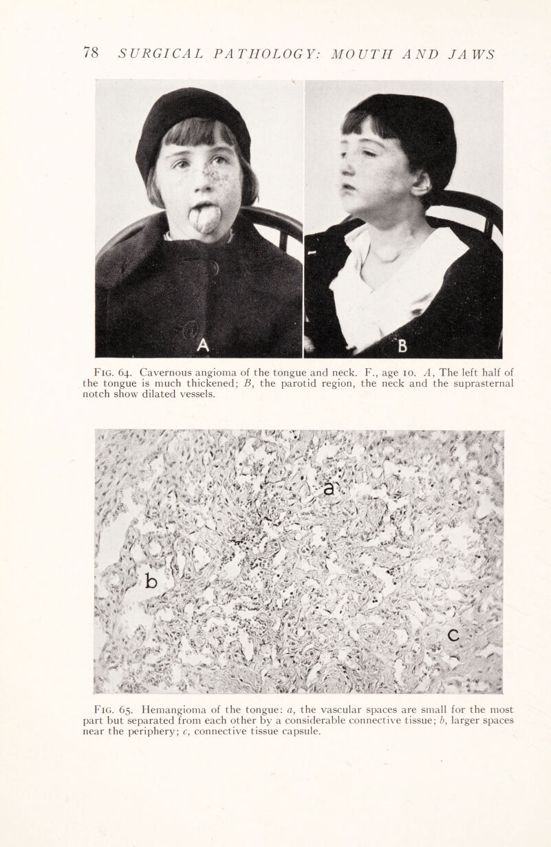 Fig. 64. Cavernous angioma of the tongue and neck. F., age 10. A, The left half of the tongue is much thickened; B, the parotid region, the neck and the suprasternal notch show dilated vessels. Fig. 65. Hemangioma of the tongue: a, the vascular spaces are small for the most part but separated from each other by a considerable connective tissue; b, larger spaces near the periphery; c, connective tissue capsule.