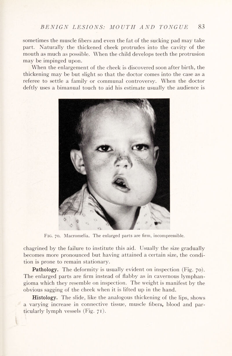 sometimes the muscle fibers and even the fat of the sucking pad may take part. Naturally the thickened cheek protrudes into the cavity of the mouth as much as possible. When the child develops teeth the protrusion may be impinged upon. When the enlargement of the cheek is discovered soon after birth, the thickening may be but slight so that the doctor comes into the case as a referee to settle a family or communal controversy. When the doctor deftly uses a bimanual touch to aid his estimate usually the audience is Fig. 70. Macromelia. The enlarged parts are firm, incompressible. chagrined by the failure to institute this aid. Usually the size gradually becomes more pronounced but having attained a certain size, the condi¬ tion is prone to remain stationary. Pathology. The deformity is usually evident on inspection (Fig. 70). The enlarged parts are firm instead of flabby as in cavernous lymphan¬ gioma which they resemble on inspection. The weight is manifest by the obvious sagging of the cheek when it is lifted up in the hand. Histology. The slide, like the analogous thickening of the lips, shows a varying increase in connective tissue, muscle fibers, blood and par¬ ticularly lymph vessels (Fig. 71).