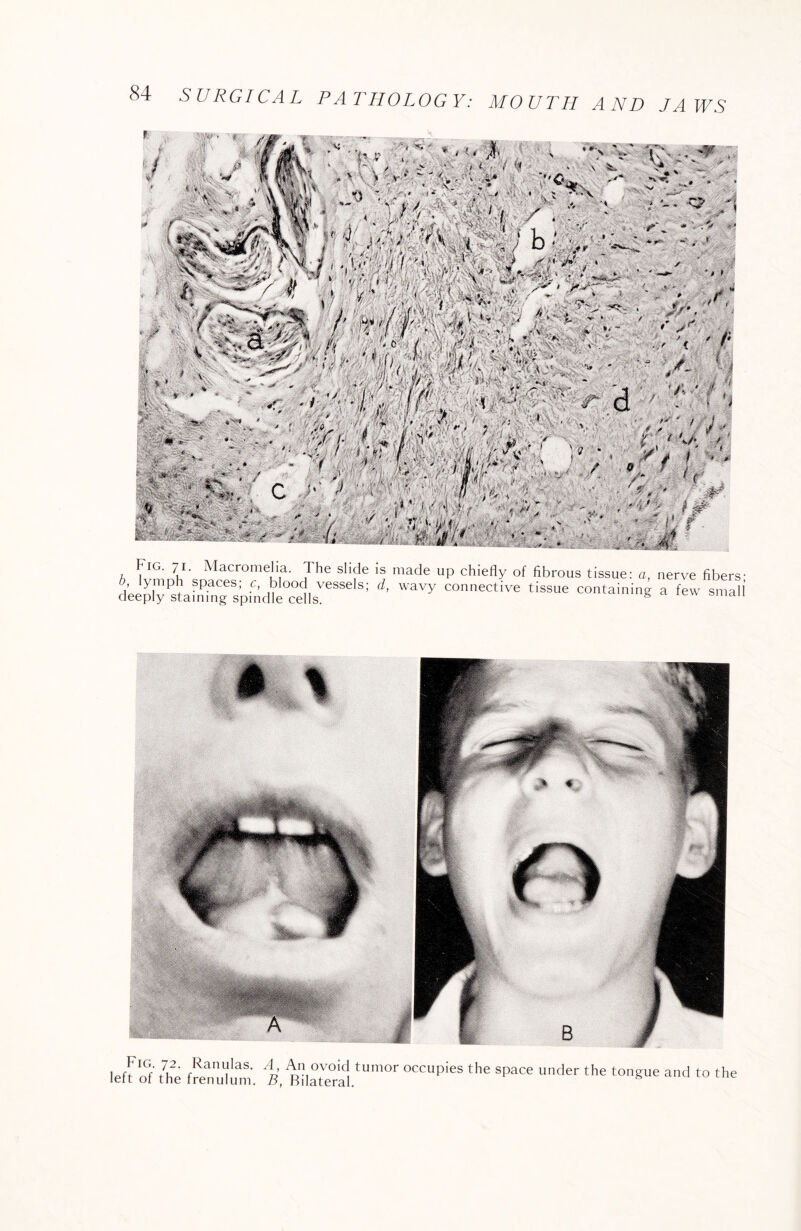 Fig. 71. Macromedia. The slide is made up chiefly of fibrous tissue: a , ymph spaces; c, blood vessels; d, wavy connective tissue containin' deeply staining spindle cells. nerve fibers; a few small left of the ftenulum. i', BilS °“UpieS the ^ U,K'er the t0nglle and to the