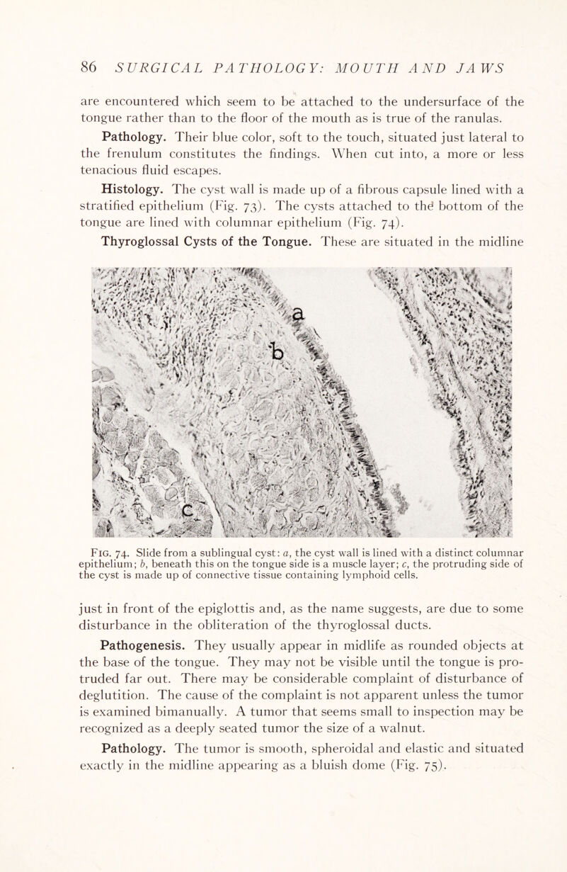 are encountered which seem to be attached to the undersurface of the tongue rather than to the floor of the mouth as is true of the ranulas. Pathology. Their blue color, soft to the touch, situated just lateral to the frenulum constitutes the findings. When cut into, a more or less tenacious fluid escapes. Histology. The cyst wall is made up of a fibrous capsule lined with a stratified epithelium (Fig. 73). The cysts attached to the! bottom of the tongue are lined with columnar epithelium (Fig. 74). Thyroglossal Cysts of the Tongue. These are situated in the midline Fig. 74. Slide from a sublingual cyst: a, the cyst wall is lined with a distinct columnar epithelium; b, beneath this on the tongue side is a muscle layer; c, the protruding side of the cyst is made up of connective tissue containing lymphoid cells. just in front of the epiglottis and, as the name suggests, are due to some disturbance in the obliteration of the thyroglossal ducts. Pathogenesis. They usually appear in midlife as rounded objects at the base of the tongue. They may not be visible until the tongue is pro¬ truded far out. There may be considerable complaint of disturbance of deglutition. The cause of the complaint is not apparent unless the tumor is examined bimanually. A tumor that seems small to inspection may be recognized as a deeply seated tumor the size of a walnut. Pathology. The tumor is smooth, spheroidal and elastic and situated exactly in the midline appearing as a bluish dome (Fig. 75).