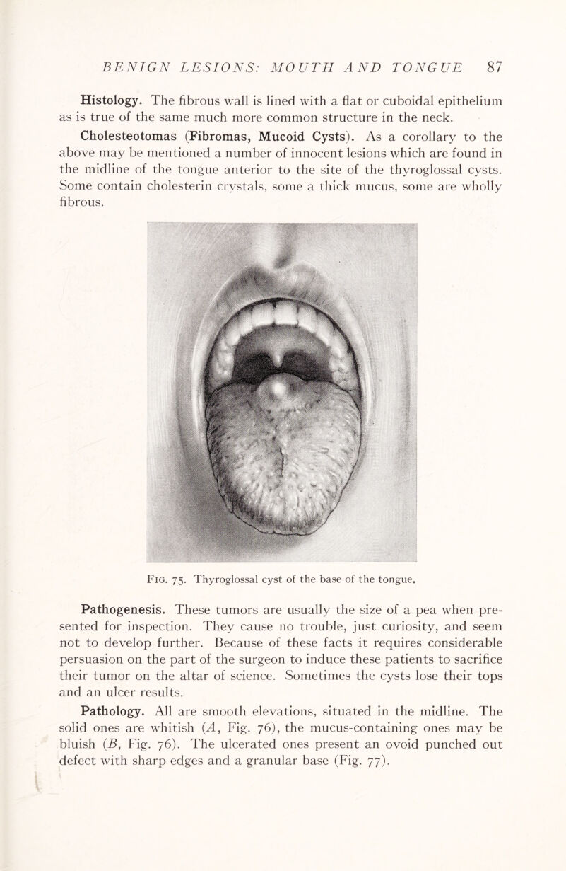 Histology. The fibrous wall is lined with a flat or cuboidal epithelium as is true of the same much more common structure in the neck. Cholesteotomas (Fibromas, Mucoid Cysts). As a corollary to the above may be mentioned a number of innocent lesions which are found in the midline of the tongue anterior to the site of the thyroglossal cysts. Some contain cholesterin crystals, some a thick mucus, some are wholly fibrous. Fig. 75. Thyroglossal cyst of the base of the tongue. Pathogenesis. These tumors are usually the size of a pea when pre¬ sented for inspection. They cause no trouble, just curiosity, and seem not to develop further. Because of these facts it requires considerable persuasion on the part of the surgeon to induce these patients to sacrifice their tumor on the altar of science. Sometimes the cysts lose their tops and an ulcer results. Pathology. All are smooth elevations, situated in the midline. The solid ones are whitish (A, Fig. 76), the mucus-containing ones may be bluish (B, Fig. 76). The ulcerated ones present an ovoid punched out defect with sharp edges and a granular base (Fig. 77).