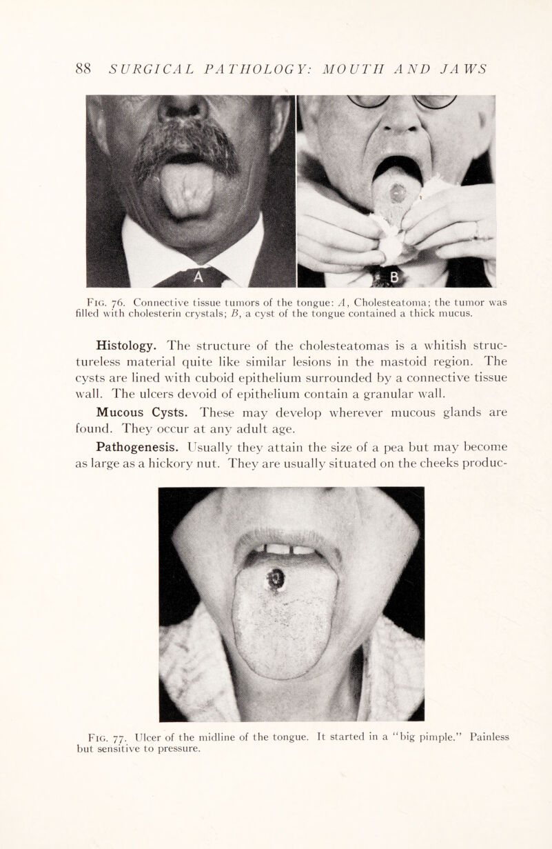 Fig. 76. Connective tissue tumors of the tongue: A, Cholesteatoma; the tumor was filled with cholesterin crystals; B, a cyst of the tongue contained a thick mucus. Histology. The structure of the cholesteatomas is a whitish struc¬ tureless material quite like similar lesions in the mastoid region. The cysts are lined with cuboid epithelium surrounded by a connective tissue wall. The ulcers devoid of epithelium contain a granular wall. Mucous Cysts. These may develop wherever mucous glands are found. They occur at any adult age. Pathogenesis. Usually they attain the size of a pea but may become as large as a hickory nut. They are usually situated on the cheeks produc- Fig. 77. Ulcer of the midline of the tongue. It started in a “big pimple.” Painless but sensitive to pressure.