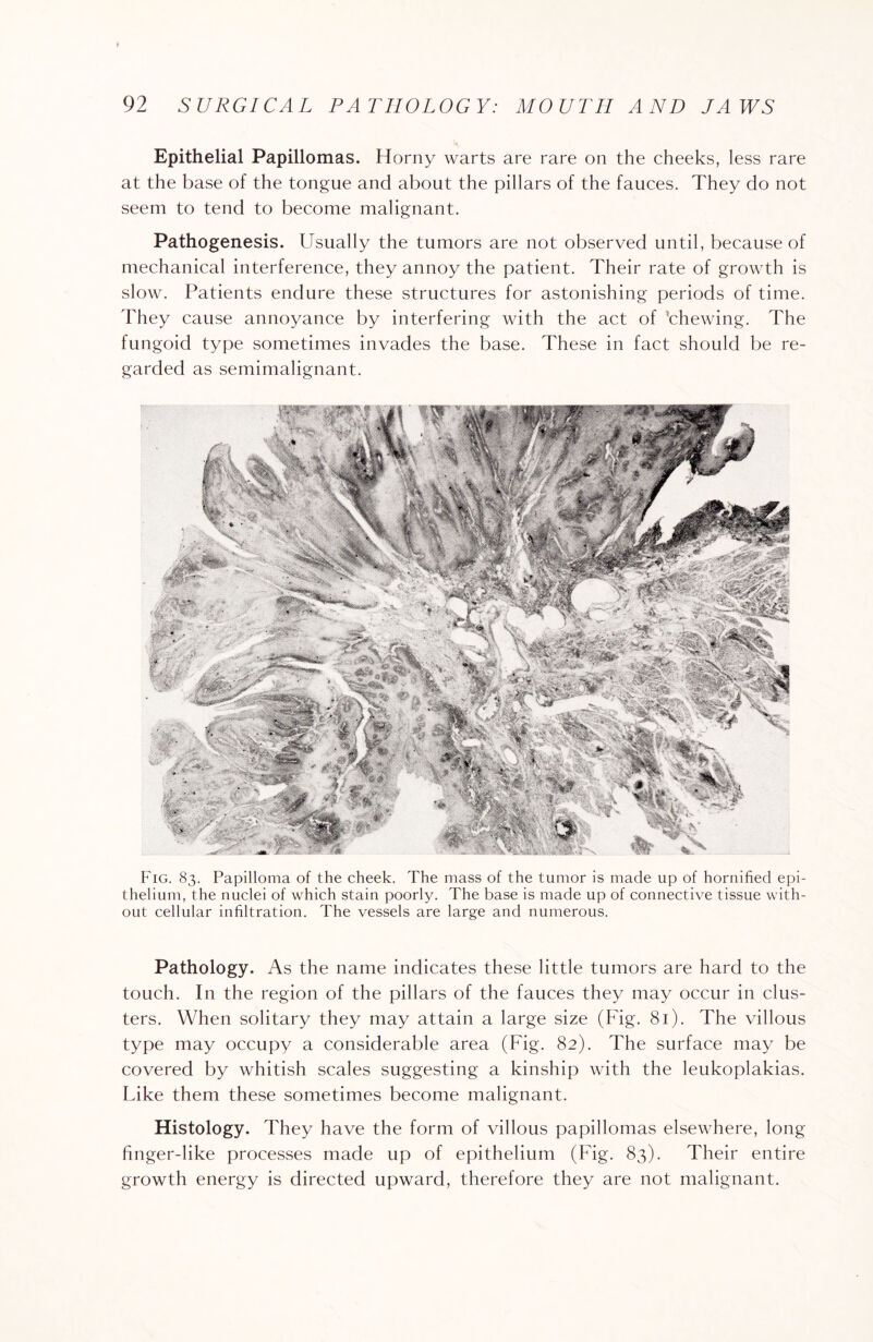 Epithelial Papillomas. Horny warts are rare on the cheeks, less rare at the base of the tongue and about the pillars of the fauces. They do not seem to tend to become malignant. Pathogenesis. Usually the tumors are not observed until, because of mechanical interference, they annoy the patient. Their rate of growth is slow. Patients endure these structures for astonishing periods of time. They cause annoyance by interfering with the act of ’chewing. The fungoid type sometimes invades the base. These in fact should be re¬ garded as semimalignant. Fig. 83. Papilloma of the cheek. The mass of the tumor is made up of hornified epi¬ thelium, the nuclei of which stain poorly. The base is made up of connective tissue with¬ out cellular infiltration. The vessels are large and numerous. Pathology. As the name indicates these little tumors are hard to the touch. In the region of the pillars of the fauces they may occur in clus¬ ters. When solitary they may attain a large size (Fig. 81). The villous type may occupy a considerable area (Fig. 82). The surface may be covered by whitish scales suggesting a kinship with the leukoplakias. Like them these sometimes become malignant. Histology. They have the form of villous papillomas elsewhere, long finger-like processes made up of epithelium (Fig. 83). Their entire growth energy is directed upward, therefore they are not malignant.