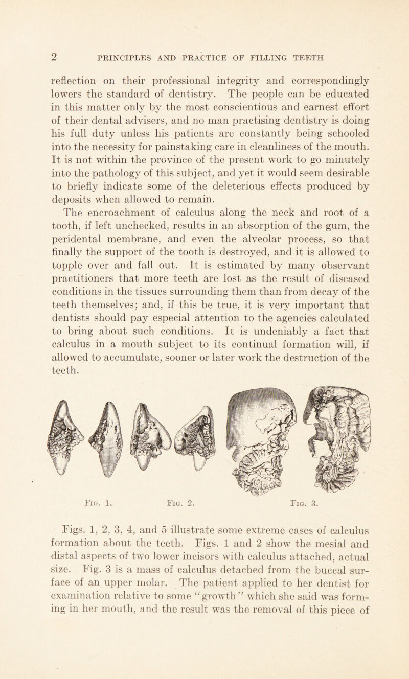 reflection on their professional integrity and correspondingly lowers the standard of dentistry. The people can be educated in this matter only by the most conscientious and earnest effort of their dental advisers, and no man practising dentistry is doing his full duty unless his patients are constantly being schooled into the necessity for painstaking care in cleanliness of the mouth. It is not within the province of the present work to go minutely into the pathology of this subject, and yet it would seem desirable to briefly indicate some of the deleterious effects produced by deposits when allowed to remain. The encroachment of calculus along the neck and root of a tooth, if left unchecked, results in an absorption of the gum, the peridental membrane, and even the alveolar process, so that finally the support of the tooth is destroyed, and it is allowed to topple over and fall out. It is estimated by many observant practitioners that more teeth are lost as the result of diseased conditions in the tissues surrounding them than from decay of the teeth themselves; and, if this be true, it is very important that dentists should pay especial attention to the agencies calculated to bring about such conditions. It is undeniably a fact that calculus in a mouth subject to its continual formation will, if allowed to accumulate, sooner or later work the destruction of the teeth. Fig. 1. Fig. 2. Fig. 3. Figs. 1, 2, 3, 4, and 5 illustrate some extreme cases of calculus formation about the teeth. Figs. 1 and 2 show the mesial and distal aspects of two lower incisors with calculus attached, actual size. Fig. 3 is a mass of calculus detached from the buccal sur¬ face of an upper molar. The patient applied to her dentist for examination relative to some “ growth ” which she said was form¬ ing in her mouth, and the result was the removal of this piece of