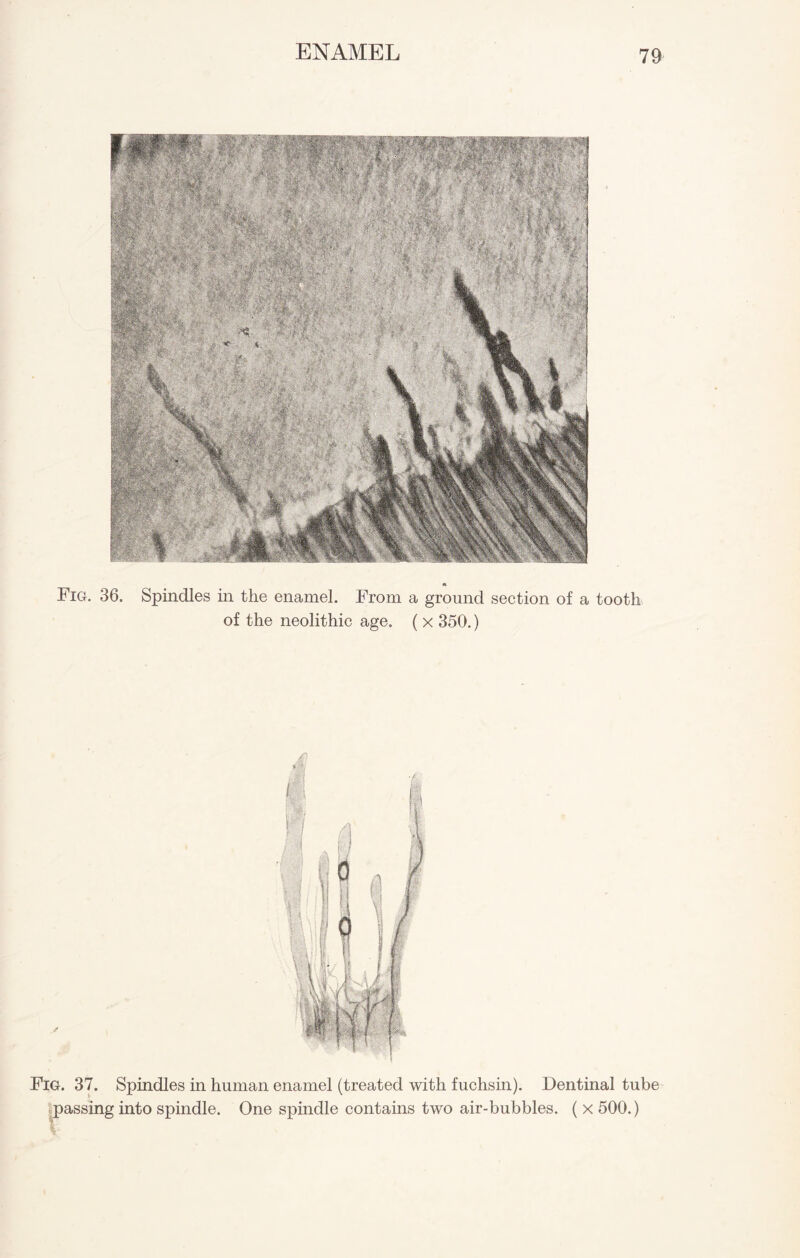 * Fig. 36. Spindles in the enamel. From a ground section of a tooth of the neolithic age. ( x 350.) Fig. 37. Spindles in human enamel (treated with fuchsin). Dentinal tube passing into spindle. One spindle contains two air-bubbles. ( x 500.) V