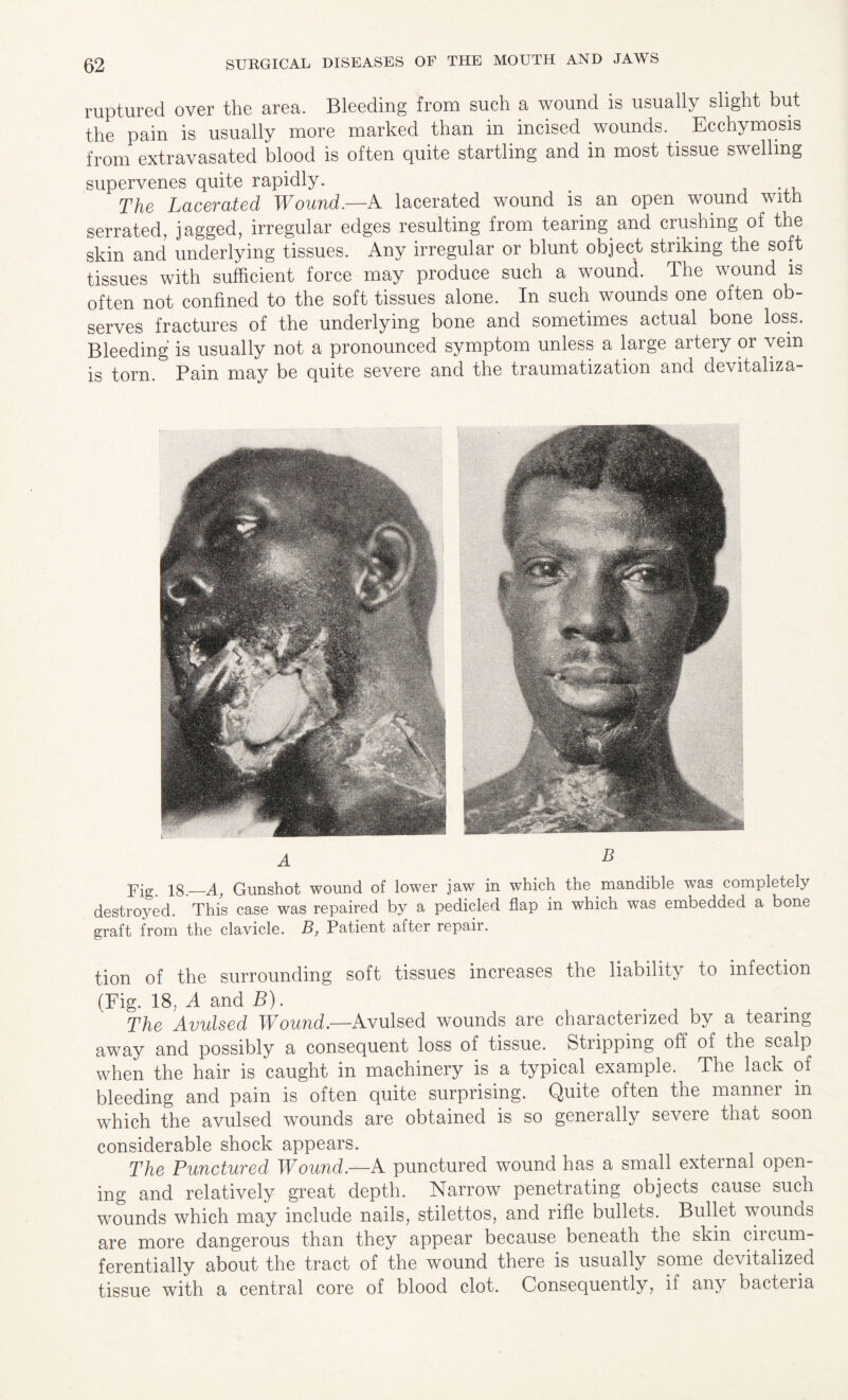 ruptured over the area. Bleeding from such a wound is usually slight but the pain is usually more marked than in incised wounds. . Ecchymosis from extravasated blood is often quite startling and in most tissue swelling supervenes quite rapidly. The Lacerated Wound.—A lacerated wound is an open wound with serrated, jagged, irregular edges resulting from tearing and crushing of the skin and underlying tissues. Any irregular or blunt object striking the soft tissues with sufficient force may produce such a wound. The wound is often not confined to the soft tissues alone. In such wounds one often ob¬ serves fractures of the underlying bone and sometimes actual bone loss. Bleeding is usually not a pronounced symptom unless a large artery or vein is torn. Pain may be quite severe and the traumatization and devitaliza- jqg is_A, Gunshot wound of lower jaw in which the mandible was completely destroyed. This case was repaired by a pedicled flap in which was embedded a bone graft from the clavicle. B, Patient after repair. tion of the surrounding soft tissues increases the liability to infection (Fig. 18. A and B). The Avulsed Wound.—Avulsed wounds are characterized by a tearing away and possibly a consequent loss of tissue. Stripping off of the scalp when the hair is caught in machinery is a typical example. The lack of bleeding and pain is often quite surprising. Quite often the manner in which the avulsed wounds are obtained is so generally severe that soon considerable shock appears. The Punctured Wound.—A punctured wound has a small external open¬ ing and relatively great depth. Narrow penetrating objects cause such wounds which may include nails, stilettos, and rifle bullets. Bullet wounds are more dangerous than they appear because beneath the skin circum¬ ferentially about the tract of the wound there is usually some devitalized tissue with a central core of blood clot. Consequently, if any bacteria