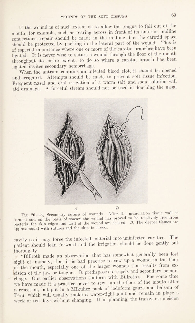 If the wound is of such extent as to allow the tongue to fall out of the mouth, for example, such as tearing across in front of its anterior midline connections, repair should be made in the midline, but the carotid space should be protected by packing in the lateral part of the wound. This is of especial importance where one or more of the carotid branches have been ligated. It is never wise to suture a wound through the floor of the mouth throughout its entire extent; to do so where a carotid branch has been ligated invites secondary hemorrhage. When the antrum contains an infected blood clot, it should be opened and irrigated. Attempts should be made to prevent soft tissue infection. Frequent nasal and oral irrigation of a warm salt and soda solution will aid drainage. A forceful stream should not be used in douching the nasal A B Fig. 20.—A, Secondary suture of wounds. After the granulation tissue wall is formed and on the basis of smears the wound has proved to be relatively free from bacteria, the skin edges and wall of the wound are excised. B, The deeper tissues are approximated with sutures and the skin is closed. cavity as it may force the infected material into uninfected cavities. The patient should lean forward and the irrigation should be done gently but thoroughly. “Billroth made an observation that has somewhat generally been lost sight of, namely, that it is bad practice to sew up a wound in the floor of the mouth, especially one of the larger wounds that results fiom ex¬ cision of the jaw or tongue. It predisposes to sepsis and secondaiy hemor¬ rhage. Our earlier observations conform with Billroth’s. For some time we have made it a practice never to sew up the floor of the mouth aftci a resection, but put in a Mikulicz pack of iodoform gauze and balsam of Peru, which will usually make a water-tight joint and remain in place a week or ten days without changing. If in planning, the transverse incision