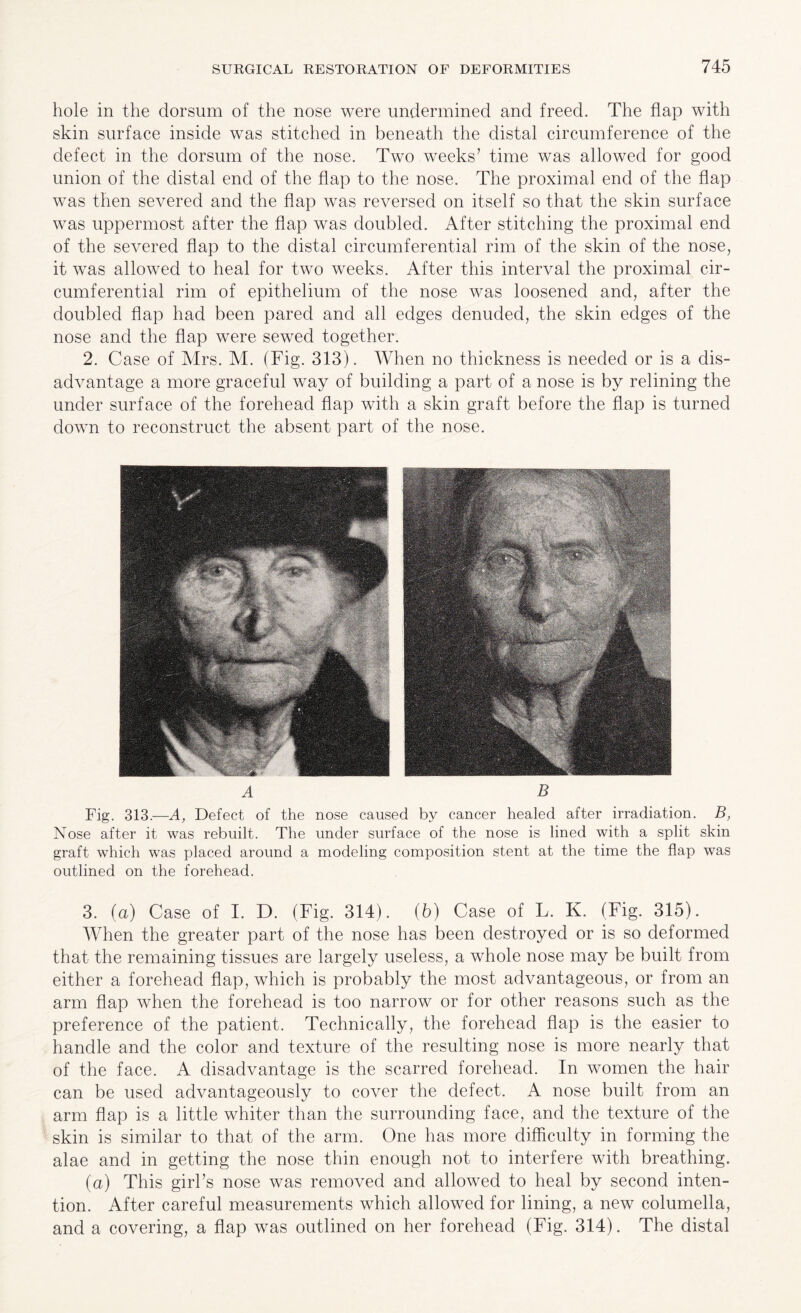 hole in the dorsum of the nose were undermined and freed. The flap with skin surface inside was stitched in beneath the distal circumference of the defect in the dorsum of the nose. Two weeks’ time was allowed for good union of the distal end of the flap to the nose. The proximal end of the flap was then severed and the flap was reversed on itself so that the skin surface was uppermost after the flap was doubled. After stitching the proximal end of the severed flap to the distal circumferential rim of the skin of the nose, it was allowed to heal for two weeks. After this interval the proximal cir¬ cumferential rim of epithelium of the nose was loosened and, after the doubled flap had been pared and all edges denuded, the skin edges of the nose and the flap were sewed together. 2. Case of Mrs. M. (Fig. 313). When do thickness is needed or is a dis¬ advantage a more graceful way of building a part of a nose is by relining the under surface of the forehead flap with a skin graft before the flap is turned down to reconstruct the absent part of the nose. A B Fig. 313.—A, Defect of the nose caused by cancer healed after irradiation. B, Nose after it was rebuilt. The under surface of the nose is lined with a split skin graft which was placed around a modeling composition stent at the time the flap was outlined on the forehead. 3. (a) Case of I. D. (Fig. 314). (b) Case of L. K. (Fig. 315). When the greater part of the nose has been destroyed or is so deformed that the remaining tissues are largely useless, a whole nose may be built from either a forehead flap, which is probably the most advantageous, or from an arm flap when the forehead is too narrow or for other reasons such as the preference of the patient. Technically, the forehead flap is the easier to handle and the color and texture of the resulting nose is more nearly that of the face. A disadvantage is the scarred forehead. In women the hair can be used advantageously to cover the defect. A nose built from an arm flap is a little whiter than the surrounding face, and the texture of the skin is similar to that, of the arm. One lias more difficulty in forming the alae and in getting the nose thin enough not to interfere with breathing. (a) This girl’s nose was removed and allowed to heal by second inten¬ tion. After careful measurements which allowed for lining, a new columella, and a covering, a flap was outlined on her forehead (Fig. 314). The distal