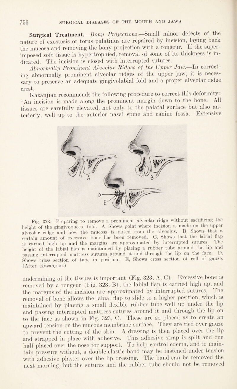 Surgical Treatment.—Bony Projections.—Small minor defects of the nature of exostosis or torus palatinus are repaired by incision, laying back the mucosa and removing the bony projection with a rongeur. If the super¬ imposed soft tissue is hypertrophied, removal of some of its thickness is in¬ dicated. The incision is closed with interrupted sutures. Abnormally Prominent Alveolar Ridges of the Upper Jaw.—In correct¬ ing abnormally prominent alveolar ridges of the upper jaw, it is neces¬ sary to preserve an adequate gingivolabial fold and a proper alveolar ridge crest. Kazanjian recommends the following procedure to correct this deformity: '•An incision is made along the prominent margin down to the bone. All tissues are carefully elevated, not only to the palatal surface but also an¬ teriorly, well up to the anterior nasal spine and canine fossa. Extensive Pig. 323._Preparing to remove a prominent alveolar ridge without sacrificing the height of the gingivobuccal fold. A, Shows point where incision is made on the uppei alveolar ridge and how the mucosa is raised from the alveolus. B, Shows that a certain amount of excessive bone has been removed. C, Shows that the labial flap is carried high up and the margins are approximated by interrupted sutures. The height of the labial flap is maintained by placing a rubber tube around the lip and passing interrupted mattress sutures around it and through the lip on the face. D, Shows cross section of tube in position. E, Shows cross section of roll of gauze. (After Kazanjian.) undermining of the tissues is important (Fig. 323, A, C). Excessive bone is removed by a rongeur (Fig. 323, B), the labial flap is carried high up, and the margins of the incision are approximated by interrupted sutures. The removal of bone allows the labial flap to slide to a higher position, which is maintained by placing a small flexible rubber tube well up under the lip and passing interrupted mattress sutures around it and through the lip on to the face as shown in Fig. 323, C. These are so placed as to create an upward tension on the mucous membrane surface. They are tied over gauze to prevent the cutting of the skin. A dressing is then placed over the lip and strapped in place with adhesive. This adhesive strap is split and one half placed over the nose for support. To help control edema, and to main¬ tain pressure without, a double elastic band may be fastened under tension with adhesive plaster over the lip dressing. The band can be removed the next morning, but the sutures and the rubber tube should not be removed