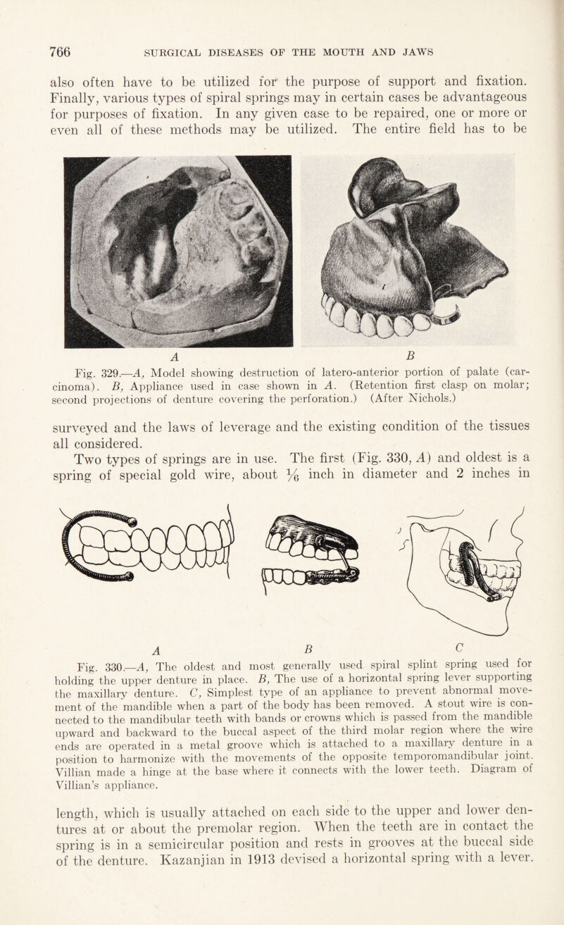 also often have to be utilized for the purpose of support and fixation. Finally, various types of spiral springs may in certain cases be advantageous for purposes of fixation. In any given case to be repaired, one or more or even all of these methods may be utilized. The entire field has to be A B Fig. 329.—A, Model showing destruction of latero-anterior portion of palate (car¬ cinoma). B, Appliance used in case shown in A. (Retention first clasp on molar; second projections of denture covering the perforation.) (After Nichols.) surveyed and the laws of leverage and the existing condition of the tissues all considered. Two types of springs are in use. The first (Fig. 330, A) and oldest is a spring of special gold wire, about Yq inch in diameter and 2 inches in ABC Fig. 330.—A, The oldest and most generally used spiral splint spring used for holding the upper denture in place. B, The use of a horizontal spring lever supporting the maxillary denture. C, Simplest type of an appliance to prevent abnoimal move¬ ment of the mandible when a part of the body has been removed. A stout wire is con¬ nected to the mandibular teeth with bands or crowns which is passed irom the mandible upward and backward to the buccal aspect of the third molar region where the wiie ends are operated in a metal groove which is attached to a maxillary denture in a position to harmonize with the movements of the opposite temporomandibulai joint. Villian made a hinge at the base where it connects with the lower teeth. Diagram of Villian’s appliance. length, which is usually attached on each side to the upper and lower den¬ tures at or about the premolar region. When the teeth are in contact the spring is in a semicircular position and rests in grooves at the buccal side of the denture. Kazanjian in 1913 devised a horizontal spring with a lever.