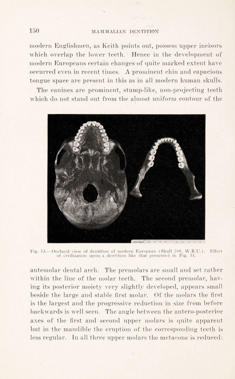 modern Englishmen, as Keith points out, possess upper incisors which overlap the lower teeth. Hence in the development of modern Europeans certain changes of quite marked extent have occurred even in recent times. A prominent chin and capacious tongue space are present in this as in all modern human skulls. The canines are prominent, stump-like, non-projecting teeth which do not stand out from the almost uniform contour of the Fig. 53.—Occlusal view of dentition of modern European (Skull 248, W.R.U.). Effect of civilization upon/ a dentition like that presented in Fig. 51. antemolar dental arch. The premolars are small and set rather within the line of the molar teeth. The second premolar, hav¬ ing its posterior moiety very slightly developed, appears small beside the large and stable first molar. Of the molars the first is the largest and the progressive reduction in size from before backwards is well seen. The angle between the antero-posterior axes of the first and second upper molars is quite apparent but in the mandible the eruption of the corresponding teeth is less regular. In all three upper molars the metacone is reduced: