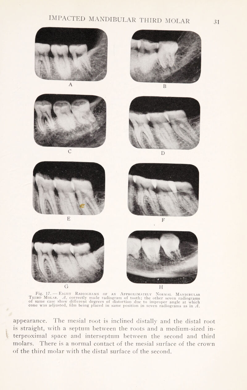 31 Fig. 17. — Eight Radiograms of an Approximately Normal Mandibular Third Molar. A, correctly made radiogram of tooth; the other seven radiograms of same case show different degrees of distortion due to improper angle at which cone was adjusted, film being placed in same position in seven radiograms as in A. appearance. The mesial root is inclined distally and the distal root is straight, with a septum between the roots and a medium-sized in- terproximal space and interseptum between the second and third molars. There is a normal contact of the mesial surface of the crown of the third molar with the distal surface of the second.