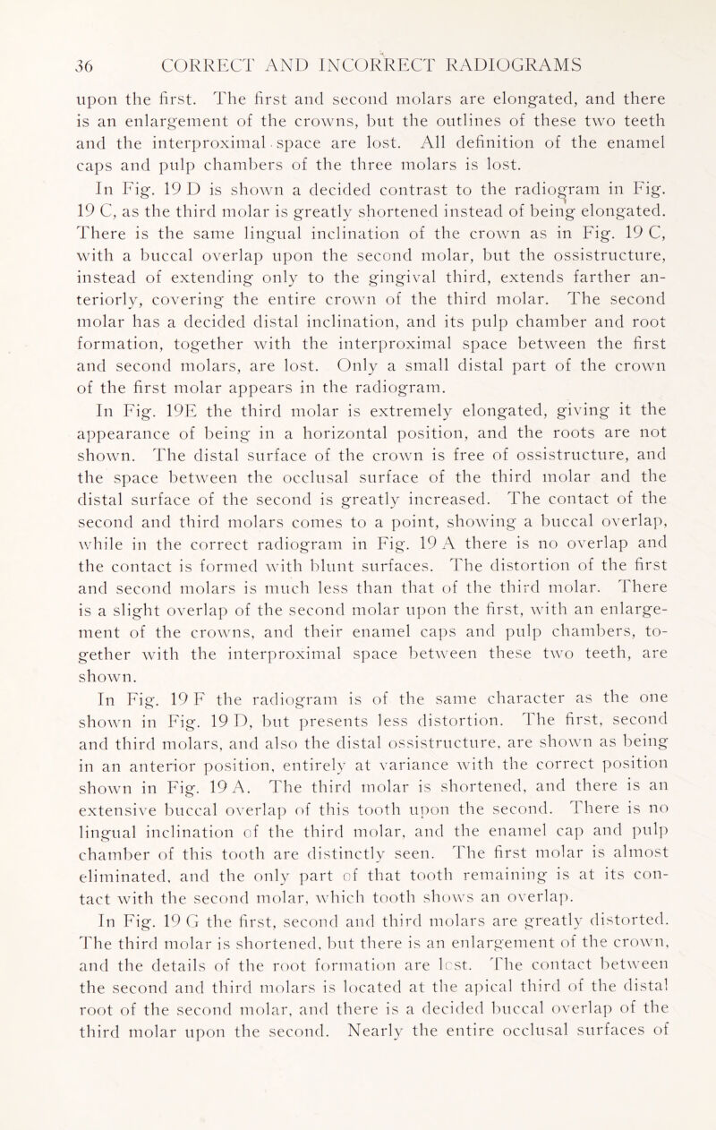 upon the first. The first and second molars are elongated, and there is an enlargement of the crowns, but the outlines of these two teeth and the interproximal space are lost. All definition of the enamel caps and pulp chambers of the three molars is lost. In Fig. 19 D is shown a decided contrast to the radiogram in Fig. 19 C, as the third molar is greatly shortened instead of being elongated. There is the same lingual inclination of the crown as in Fig. 19 C, with a buccal overlap upon the second molar, but the ossistructure, instead of extending only to the gingival third, extends farther an¬ teriorly, covering the entire crown of the third molar. The second molar has a decided distal inclination, and its pulp chamber and root formation, together with the interproximal space between the first and second molars, are lost. Only a small distal part of the crown of the first molar appears in the radiogram. In Fig. 19E the third molar is extremely elongated, giving it the appearance of being in a horizontal position, and the roots are not shown. The distal surface of the crown is free of ossistructure, and the space between the occlusal surface of the third molar and the distal surface of the second is greatly increased. The contact of the second and third molars comes to a point, showing a buccal overlap, while in the correct radiogram in Fig. 19 A there is no overlap and the contact is formed with blunt surfaces. The distortion of the first and second molars is much less than that of the third molar. There is a slight overlap of the second molar upon the first, with an enlarge¬ ment of the crowns, and their enamel caps and pulp chambers, to¬ gether with the interproximal space between these two teeth, are shown. In Fig. 19 F the radiogram is of the same character as the one shown in Fig. 19 D, but presents less distortion. The first, second and third molars, and also the distal ossistructure, are shown as being in an anterior position, entirely at variance with the correct position shown in Fig. 19 A. \ he third molar is shortened, and there is an extensive buccal overlap of this tooth upon the second. There is no lingual inclination of the third molar, and the enamel cap and pulp chamber of this tooth are distinctly seen. The first molar is almost eliminated, and the only part of that tooth remaining is at its con¬ tact with the second molar, which tooth shows an overlap. In Fig. 19 G the first, second and third molars are greatly distorted. The third molar is shortened, but there is an enlargement of the crown, and the details of the root formation are lost. The contact between the second and third molars is located at the apical third of the distal root of the second molar, and there is a decided buccal overlap of the third molar upon the second. Nearly the entire occlusal surfaces of