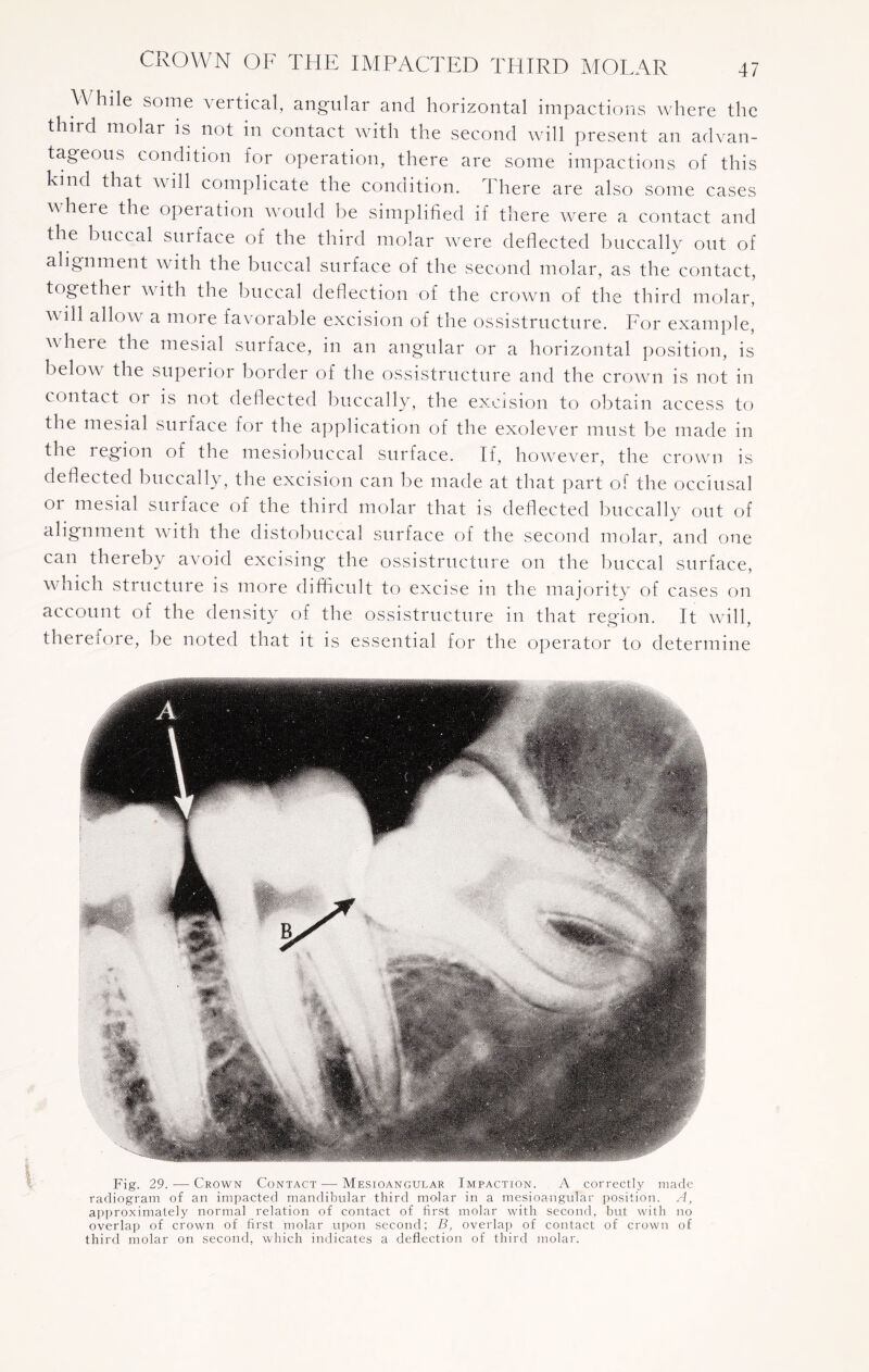 While some vertical, angular and horizontal impactions where the third molar is not in contact with the second will present an advan¬ tageous condition for operation, there are some impactions of this kind that w ill complicate the condition. There are also some cases wheie the opeiation would be simplified if there were a contact and the buccal surface of the third molar were deflected buccally out of alignment with the buccal surface of the second molar, as the contact, together with the buccal deflection of the crown of the third molar, ill allow a more favorable excision of the ossistructure. For example, where the mesial surface, in an angular or a horizontal position, is below the superior border of the ossistructure and the crown is not in contact or is not deflected buccally, the excision to obtain access to the mesial surface for the application of the exolever must be made in the legion of the mesiobuccal surface. If, however, the crown is deflected buccally, the excision can be made at that part of the occlusal 01 mesial surface of the third molar that is deflected buccally out of alignment with the distobuccal surface of the second molar, and one can thereby avoid excising the ossistructure on the buccal surface, which structure is more difficult to excise in the majority of cases on account of the density of the ossistructure in that region. It will, there 1 ore, be noted that it is essential for the operator to determine Fig. 29.— Crown Contact — Mesioangular Impaction. A correctly made radiogram of an impacted mandibular third molar in a mesioangular position. A, approximately normal relation of contact of first molar with second, but with no overlap of crown of first molar upon second; B, overlap of contact of crown of third molar on second, which indicates a deflection of third molar.