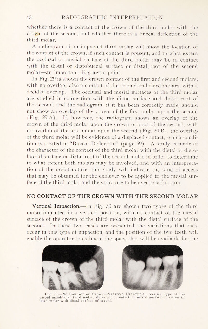 whether there is a contact of the crown of the third molar with the crown of the second, and whether there is a buccal deflection of the third molar. A radiogram of an impacted third molar will show the location of the contact of the crown, if such contact is present, and to what extent the occlusal or mesial surface of the third molar may'be in contact with the distal or distobuccal surface or distal root of the second molar—an important diagnostic point. In Fig. 29 is shown the crown contact of the first and second molars, with no overlap ; also a contact of the second and third molars, with a decided overlap. The occlusal and mesial surfaces of the third molar are studied in connection with the distal surface and distal root of the second, and the radiogram, if it has been correctly made, should not show an overlap of the crown of the first molar upon the second (Fig. 29 A). If, however, the radiogram shows an overlap of the crown of the third molar upon the crown or root of the second, with no overlap of the first molar upon the second (Fig. 29 Bj, the overlap of the third molar will be evidence of a displaced contact, which condi¬ tion is treated in “Buccal Deflection” (page 59). A study is made of the character of the contact of the third molar with the distal or disto¬ buccal surface or distal root of the second molar in order to determine to what extent both molars may be involved, and with an interpreta¬ tion of the ossistructure, this study will indicate the kind of access that may be obtained for the exolever to be applied to the mesial sur¬ face of the third molar and the structure to be used as a fulcrum. NO CONTACT OF THE CROWN WITH THE SECOND MOLAR Vertical Impaction.—In Fig. 30 are shown two types of the third molar impacted in a vertical position, with no contact of the mesial surface of the crown of the third molar with the distal surface of the second. In these two cases are presented the variations that may occur in this type of impaction, and the position of the two teeth will enable the operator to estimate the space that will be available for the Fig. 30.—No Contact of Crown—Vertical Impaction. Vertical type of im¬ pacted mandibular third molar, showing no contact of mesial surface of crown of third molar with distal surface of second.