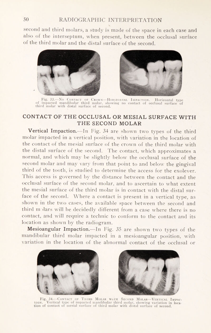 second and third molars, a study is made of the space in each case and also of the interseptum, when present, between the occlusal surface of the third molar and the distal surface of the second. Fig. 33.—No Contact of Crown—Horizontal Impaction. Horizontal type of impacted mandibular third molar, showing no contact of occlusal surface of third molar with distal surface of second. CONTACT OF THE OCCLUSAL OR MESIAL SURFACE WITH THE SECOND MOLAR Vertical Impaction.—In Pig\ 34 are shown two types of the third molar impacted in a vertical position, with variation in the location of the contact of the mesial surface of the crown of the third molar with the distal surface of the second. The contact, which approximates a normal, and which may be slightly below the occlusal surface of the second molar and may vary from that point to and below the gingival third of the tooth, is studied to determine the access for the exolever. This access is governed by the distance between the contact and the occlusal surface of the second molar, and to ascertain to what extent the mesial surface of the third molar is in contact with the distal sur¬ face of the second. 3\ here a contact is present in a vertical type, as shown in the two cases, the available space between the second and third m dars will be decidedly different from a case where there is no contact, and will require a technic to conform to the contact and its location as shown by the radiogram. Mesioangular Impaction.—In Fig. 35 are shown two types of the mandibular third molar impacted in a mesioangular position, with variation in the location of the abnormal contact of the occlusal or Fig. 34.—Contact of Third Molar with Second Molar—Vertical Impac¬ tion. Vertical type of impacted mandibular third molar, showing variation in loca¬ tion of contact of mesial surface of third molar with distal surface of second.