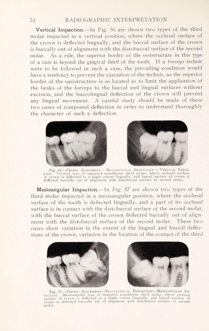 Vertical Impaction.—In Fig. 56 are shown two types of the third molar impacted in a vertical position, where the occlusal surface of the crown is deflected lingually, and the buccal surface of the crown is buccally out of alignment with the distobuccal surface of the second molar. As a rule, the superior border of the ossistructure in this type of a case is beyond the gingival third of the tooth. If a forceps technic were to be followed in such a case, the prevailing condition would have a tendency to prevent the execution of the technic, as the superior border of the ossistructure is so located as to limit the application of the beaks of the forceps to the buccal and lingual surfaces without excision, and the buccolingual deflection of the crown will prevent any lingual movement. A careful study should be made of these two cases of compound deflection in order to understand thoroughly the character of such a deflection. Fig. 56.—Crown Alignment — Buccolingual Deflection — Vertical Impac¬ tion. Vertical type of impacted mandibular third molar, where occlusal surface of crown is deflected to a slight extent lingually, and buccal surface of crown is deflected buccally out of alignment with distobuccal surface of second molar. Mesioangular Impaction.—In Fig. 57 are shown two types of the third molar impacted in a mesioangular position, where the occlusal surface of the tooth is deflected lingually, and a part of its occlusal surface is in contact with the distobuccal surface of the second molar, with the buccal surface of the crown deflected buccally out of align¬ ment with the distobuccal surface of the second molar. These two cases show variation in the extent of the lingual and buccal deflec¬ tions of the crown, variation in the location of the contact of the third pjg 57__Crown Alignment—Buccolingual Deflection—Mesioangular Im¬ paction. Mesioangular type of impacted mandibular third molar, where occlusal surface of crown is deflected to a slight extent lingually, and buccal surface of crown is deflected buccally out of alignment with distobuccal surface of second molar.