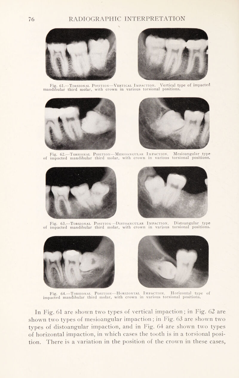 Fig. 61.—Torsional Position—Vertical Impaction. Vertical type of impacted mandibular third molar, with crown in various torsional positions. Fig. 62.—Torsional Position—Mesioangular Impaction. Mesioangular type of impacted mandibular third molar, with crown in various torsional positions. Fig. 63.—Torsional Position —Distoangular Impaction. Distoangular type of impacted mandibular third molar, with crown in various torsional positions. Fig. 64.—Torsional Position—PIorizontal Impaction. Horizontal type of impacted mandibular third molar, with crown in various torsional positions. In Fig. 61 are shown two types of vertical impaction; in Fig. 62 are shown two types of mesioangular impaction; in Fig. 63 are shown two types of distoangular impaction, and in Fig. 64 are shown two types of horizontal impaction, in which cases the tooth is in a torsional posi¬ tion. There is a variation in the position of the crown in these cases,