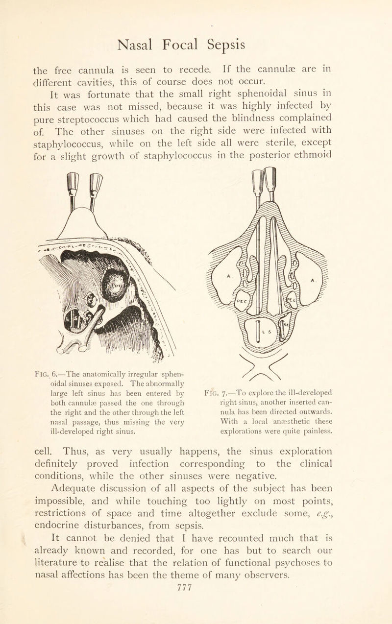 the free cannula is seen to recede. If the cannulae are in different cavities, this of course does not occur. It was fortunate that the small right sphenoidal sinus in this case was not missed, because it was highly infected by pure streptococcus which had caused the blindness complained of. The other sinuses on the right side were infected with staphylococcus, while on the left side all were sterile, except for a slight growth of staphylococcus in the posterior ethmoid Fig. 6.—The anatomically irregular sphen¬ oidal sinuses exposed. The abnormally large left sinus has been entered by both cannulae passed the one through the right and the other through the left nasal passage, thus missing the very ill-developed right sinus. Fig. 7.—To explore the ill-developed right sinus, another inserted can¬ nula has been directed outwards. With a local anaesthetic these explorations were quite painless. cell. Thus, as very usually happens, the sinus exploration definitely proved infection corresponding to the clinical conditions, while the other sinuses were negative. Adequate discussion of all aspects of the subject has been impossible, and while touching too lightly on most points, restrictions of space and time altogether exclude some, eg, endocrine disturbances, from sepsis. It cannot be denied that I have recounted much that is already known and recorded, for one has but to search our literature to realise that the relation of functional psychoses to nasal affections has been the theme of many observers. 777