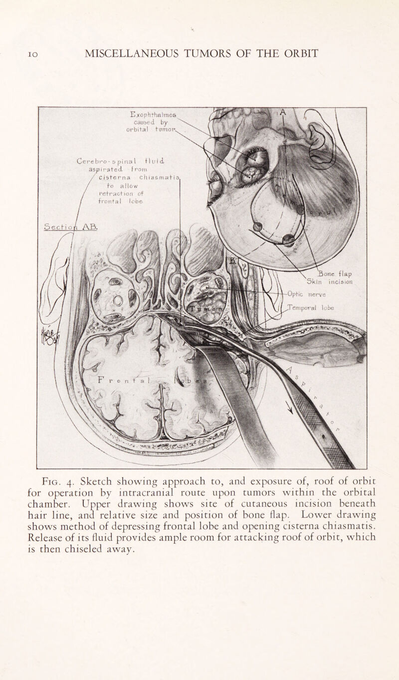 Fig. 4. Sketch showing approach to, and exposure of, roof of orbit for operation by intracranial route upon tumors within the orbital chamber. Upper drawing shows site of cutaneous incision beneath hair line, and relative size and position of bone flap. Lower drawing shows method of depressing frontal lobe and opening cisterna chiasmatis. Release of its fluid provides ample room for attacking roof of orbit, which is then chiseled away.