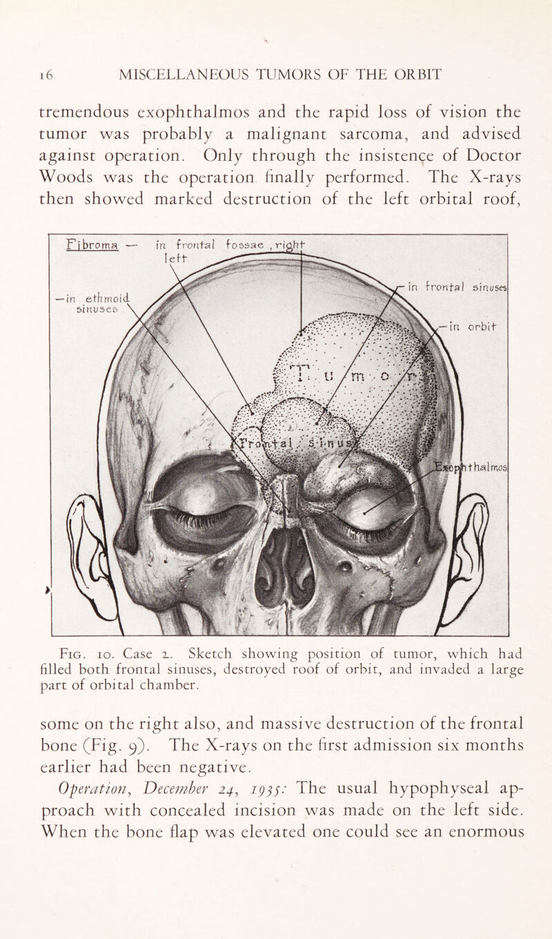 tremendous exophthalmos and the rapid loss of vision the tumor was probably a malignant sarcoma, and advised against operation. Only through the insistence of Doctor Woods was the operation finally performed. The X-rays then showed marked destruction of the left orbital roof, Fig. io. Case 2.. Sketch showing position of tumor, which had filled both frontal sinuses, destroyed roof of orbit, and invaded a large part of orbital chamber. some on the right also, and massive destruction of the frontal bone (Fig. 9). The X-rays on the first admission six months earlier had been negative. Operation, December 24, 1944: The usual hypophyseal ap¬ proach with concealed incision was made on the left side. When the bone flap was elevated one could see an enormous thalmos Fibroma in frontal fossae , ri left — in ethmoid sinuses in frontal sinuses tn orbit