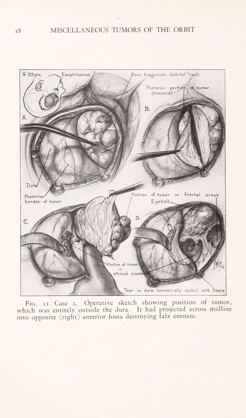 fragments (orbital ' rpot) Posterior portion,, oil ti Exophthalmos one urn or (removed.) fronfa! sinus Portion of tumor in E yeball-^^ Posterior' border of tumor •rtion of tumor ethmoid sinusi Tear in dura hermetically sealed with fascia Fig. ii. Case z. Operative sketch showing position of tumor, which was entirely outside the dura. It had projected across midline into opposite (right) anterior fossa destroying falx enroute.