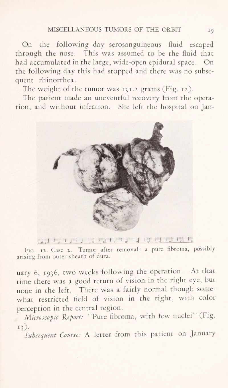 On the following day serosanguineous fluid escaped through the nose. This was assumed to be the fluid that had accumulated in the large, wide-open epidural space. On the following day this had stopped and there was no subse¬ quent rhinorrhea. The weight of the tumor was 131.x grams (Fig. ix). The patient made an uneventful recovery from the opera¬ tion, and without infection. She left the hospital on Jan- Fig. ix. Case x. Tumor after removal: a pure fibroma, possibly arising from outer sheath of dura. uary 6, 1936, two weeks following the operation. At that time there was a good return of vision in the right eye, but none in the left. There was a fairly normal though some¬ what restricted held of vision in the right, with color perception in the central region. Microscopic Report: “Pure fibroma, with few nuclei” (Fig. o)- . . T Subsequent Course: A letter from this patient on January