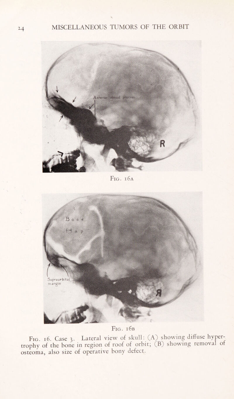 M Fig. i6a Fig. i6b Fig. i6. Case 3. Lateral view of skull: (A) showing diffuse hyper¬ trophy of the bone in region of roof of orbit; (B) showing removal of osteoma, also size of operative bony defect.