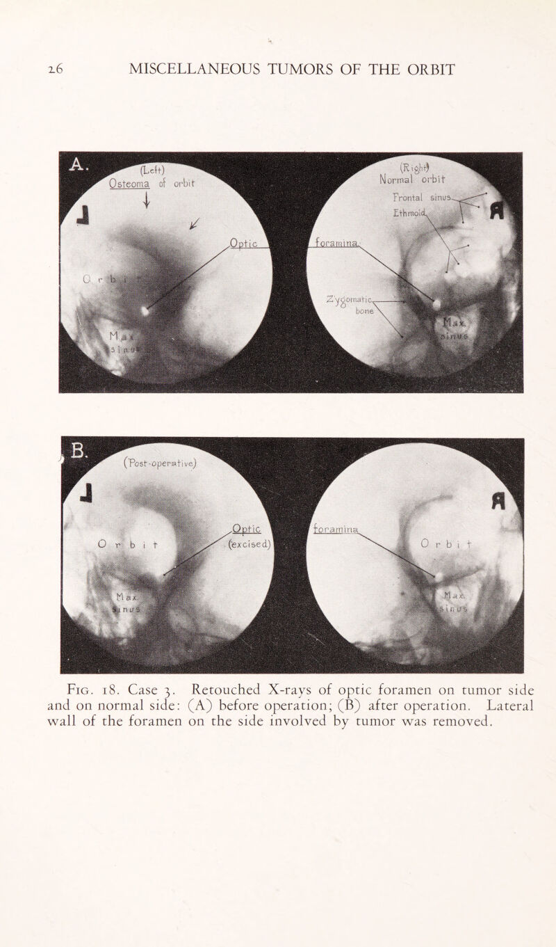 Osteoma of orbi t orma frontal stnus^ Ethmoid. 'ramma. ygomafic ■ Fig. 18. Case 3. Retouched X-rays of optic foramen on tumor side and on normal side: (A) before operation; (B) after operation. Lateral wall of the foramen on the side involved by tumor was removed.