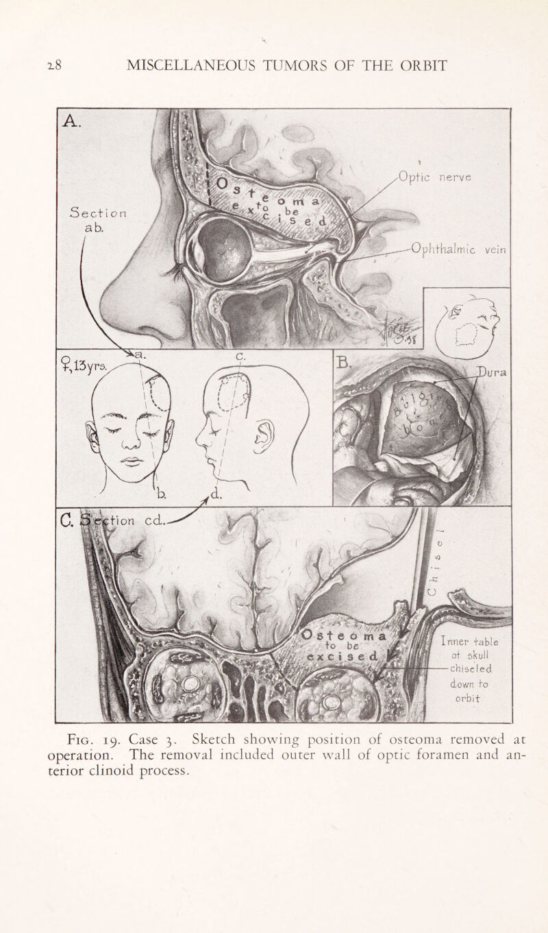 Fig. 19. Case 3. Sketch showing position of osteoma removed at operation. The removal included outer wall of optic foramen and an¬ terior clinoid process.