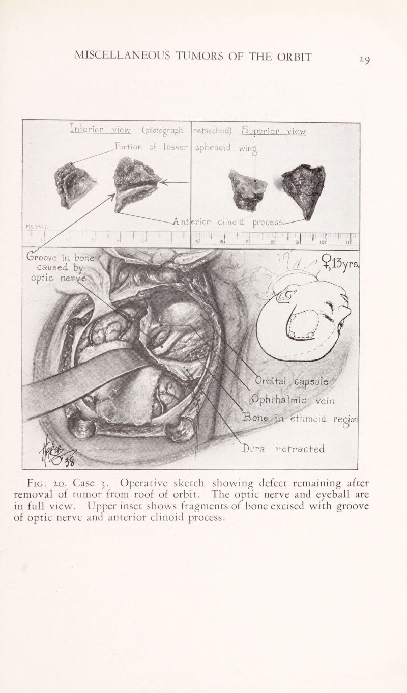 1C) TorKon of lesser enoict erior clinoid proces groove m por caused by optic nerve m! c ve i n ethmoid Di/ra retracted Inferi lor view (phorograph retouched) Superior view Fig. 10. Case 3. Operative sketch showing defect remaining after removal of tumor from roof of orbit. The optic nerve and eyeball are in full view. Upper inset shows fragments of bone excised with groove of optic nerve and anterior clinoid process.