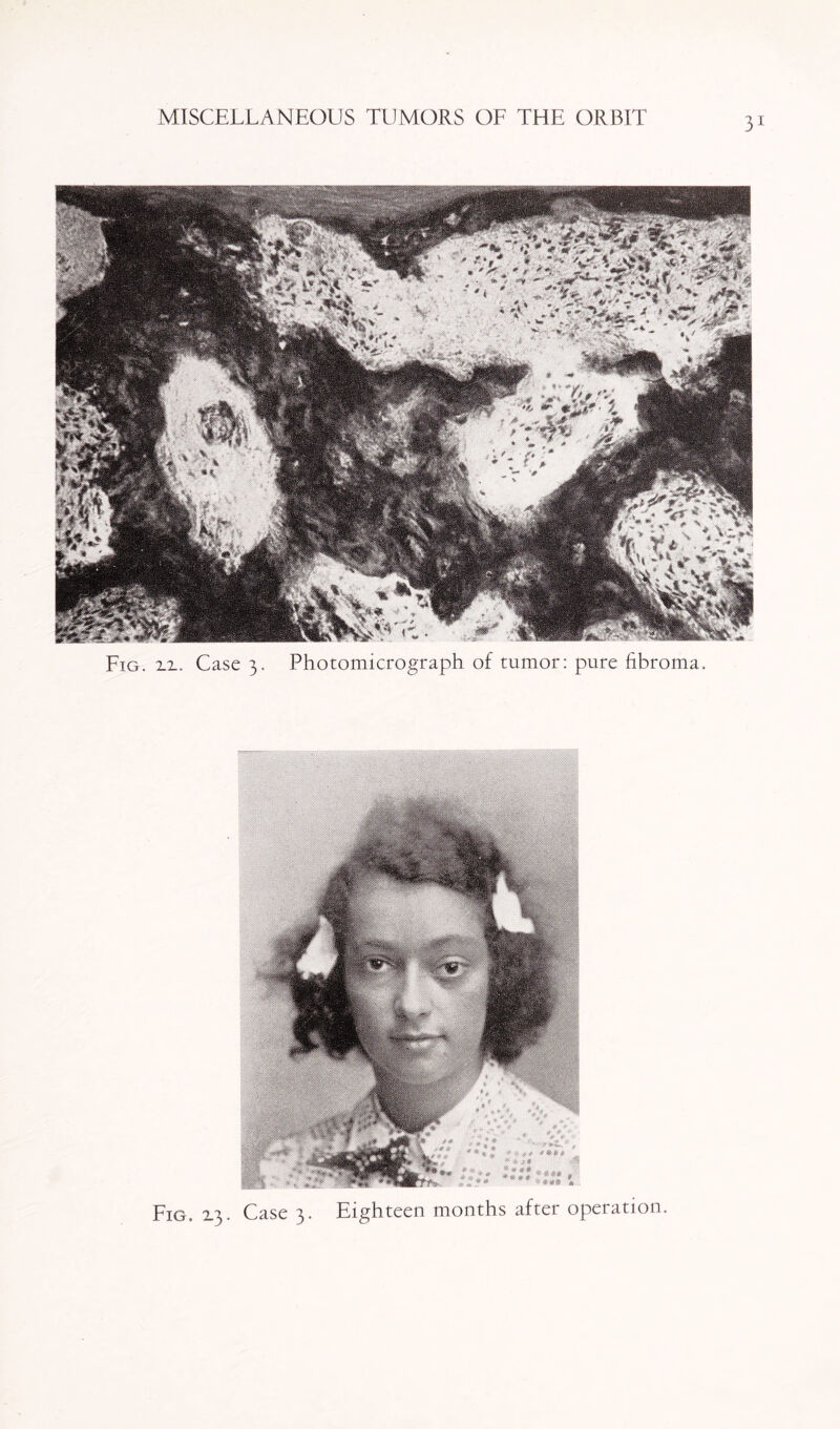 Fig. 2-2~ Case 3. Photomicrograph of tumor: pure fibroma. Fig. X3- Case 3. Eighteen months after operation.