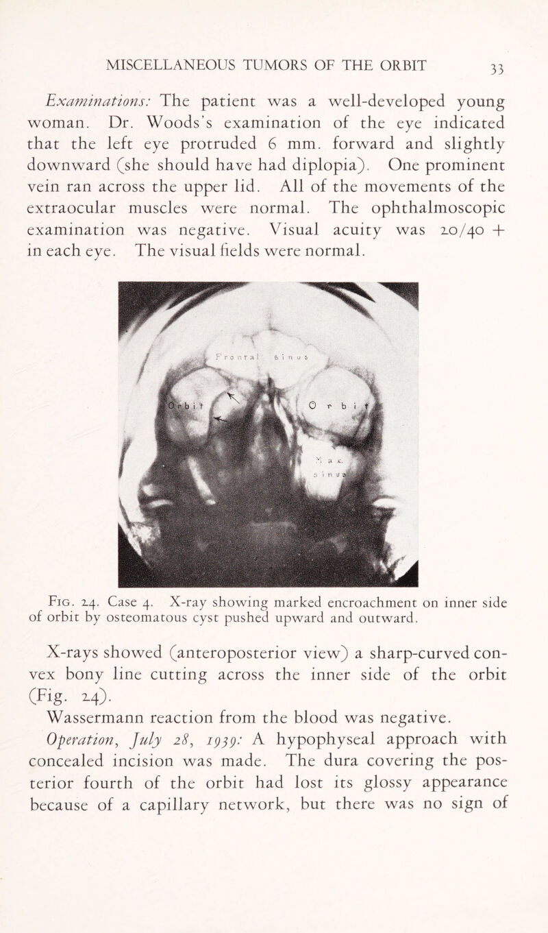 Examinations: The patient was a well-developed young woman. Dr. Woods’s examination of the eye indicated that the left eye protruded 6 mm. forward and slightly downward (she should have had diplopia). One prominent vein ran across the upper lid. All of the movements of the extraocular muscles were normal. The ophthalmoscopic examination was negative. Visual acuity was 2.0/40 + in each eye. The visual fields were normal. Fig. 14. Case 4. X-ray showing marked encroachment on inner side of orbit by osteomatous cyst pushed upward and outward. X-rays showed (anteroposterior view) a sharp-curved con¬ vex bony line cutting across the inner side of the orbit (Fig. 14). Wassermann reaction from the blood was negative. Operation, July 28, iggg: A hypophyseal approach with concealed incision was made. The dura covering the pos¬ terior fourth of the orbit had lost its glossy appearance because of a capillary network, but there was no sign of