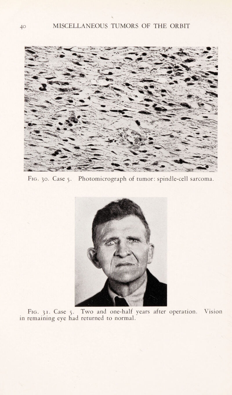 Fig. 30. Case 3. Photomicrograph of tumor: spindle-cell sarcoma. Fig. 31. Case 5. Two and one-half years after operation. Vision in remaining eye had returned to normal.