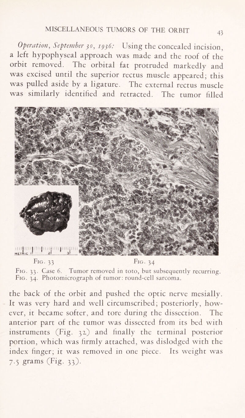 43 Operation, September 30, 1336: Using the concealed incision, a left hypophyseal approach was made and the roof of the orbit removed. The orbital fat protruded markedly and was excised until the superior rectus muscle appeared; this was pulled aside by a ligature. The external rectus muscle was similarly identified and retracted. The tumor filled Fig. 33 Fig. 34 Fig. 33. Case 6. Tumor removed in toto, but subsequently recurring. Fig. 34. Photomicrograph of tumor: round-cell sarcoma. the back of the orbit and pushed the optic nerve mesially. It was very hard and well circumscribed; posteriorly, how¬ ever, it became softer, and tore during the dissection. The anterior part of the tumor was dissected from its bed with instruments (Fig. 32.) and finally the terminal posterior portion, which was firmly attached, was dislodged with the index finger; it was removed in one piece. Its weight was 7.5 grams (Fig. 33).