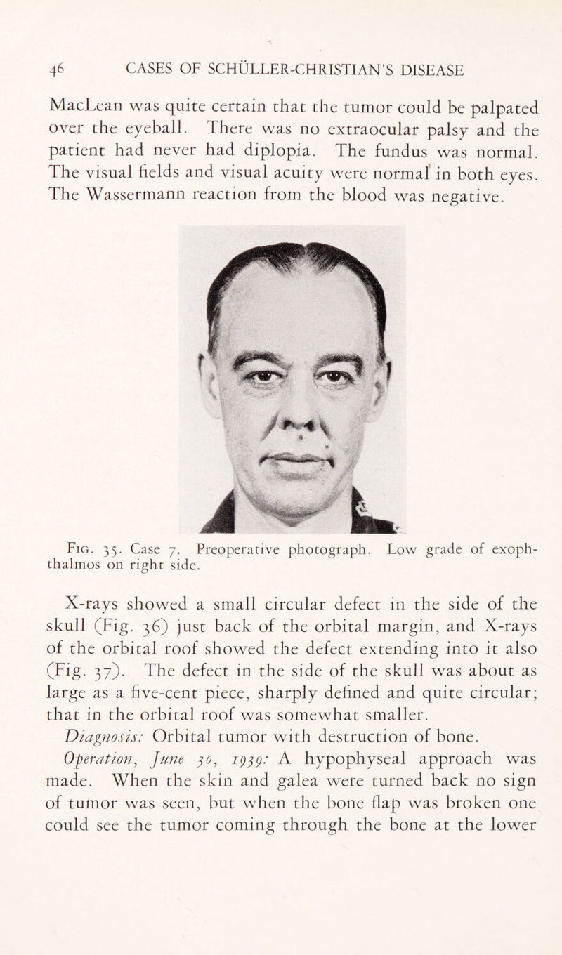 MacLean was quite certain that the tumor could be palpated over the eyeball. There was no extraocular palsy and the patient had never had diplopia. The fundus was normal. The visual fields and visual acuity were normal in both eyes. The Wassermann reaction from the blood was negative. Fig. 35. Case 7. Preoperative photograph. Low grade of exoph¬ thalmos on right side. X-rays showed a small circular defect in the side of the skull (Fig. 36) just back of the orbital margin, and X-rays of the orbital roof showed the defect extending into it also (Fig. 37). The defect in the side of the skull was about as large as a five-cent piece, sharply defined and quite circular; that in the orbital roof was somewhat smaller. Diagnosis: Orbital tumor with destruction of bone. Operation, June 30, 1939: A hypophyseal approach was made. When the skin and galea were turned back no sign of tumor was seen, but when the bone flap was broken one could see the tumor coming through the bone at the lower