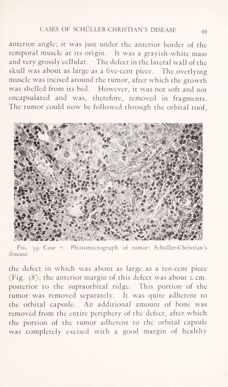 anterior angle; it was just under the anterior border of the temporal muscle at its origin. It was a grayish-white mass and very grossly cellular. The defect in the lateral wall of the skull was about as large as a hve-cent piece. The overlying muscle was incised around the tumor, after which the growth was shelled from its bed. However, it was not soft and not encapsulated and was, therefore, removed in fragments. The tumor could now be followed through the orbital roof, Fig. 39. Case 7. Photomicrograph of tumor: Schiiller-Christian’s disease. the defect in which was about as large as a ten-cent piece (Fig. 38); the anterior margin of this defect was about 2. cm. posterior to the supraorbital ridge. This portion of the tumor was removed separately. It was quite adherent to the orbital capsule. An additional amount of bone was removed from the entire periphery of the defect, after which the portion of the tumor adherent to the orbital capsule was completely excised with a good margin of healthy